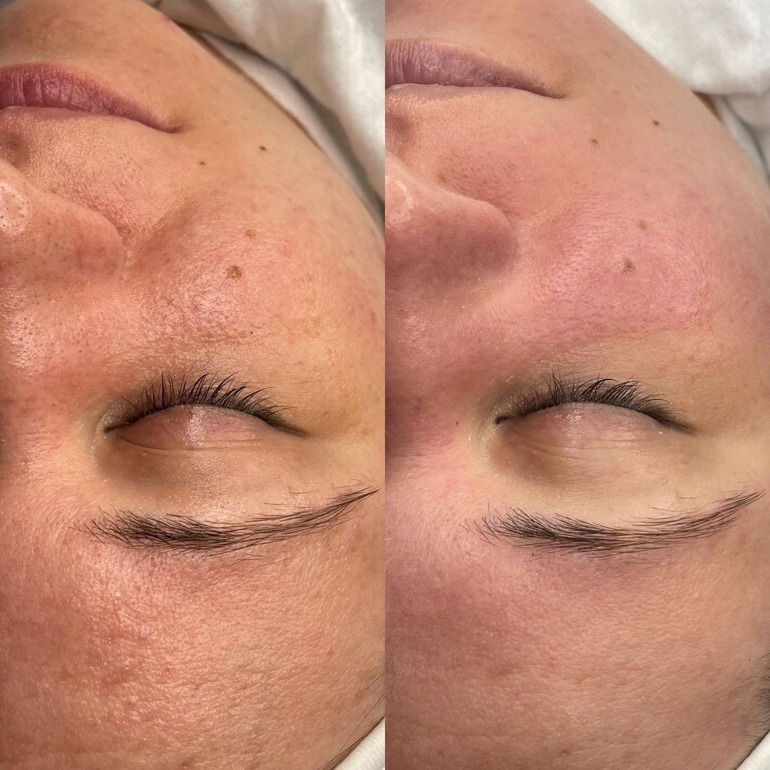 Chemical Peel Ctrl Alt Skin