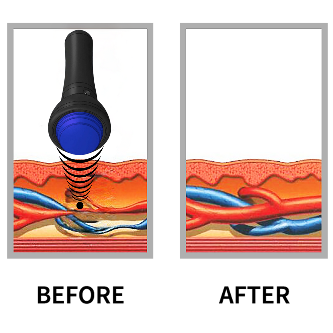 How GAINSWave® Therapy Works