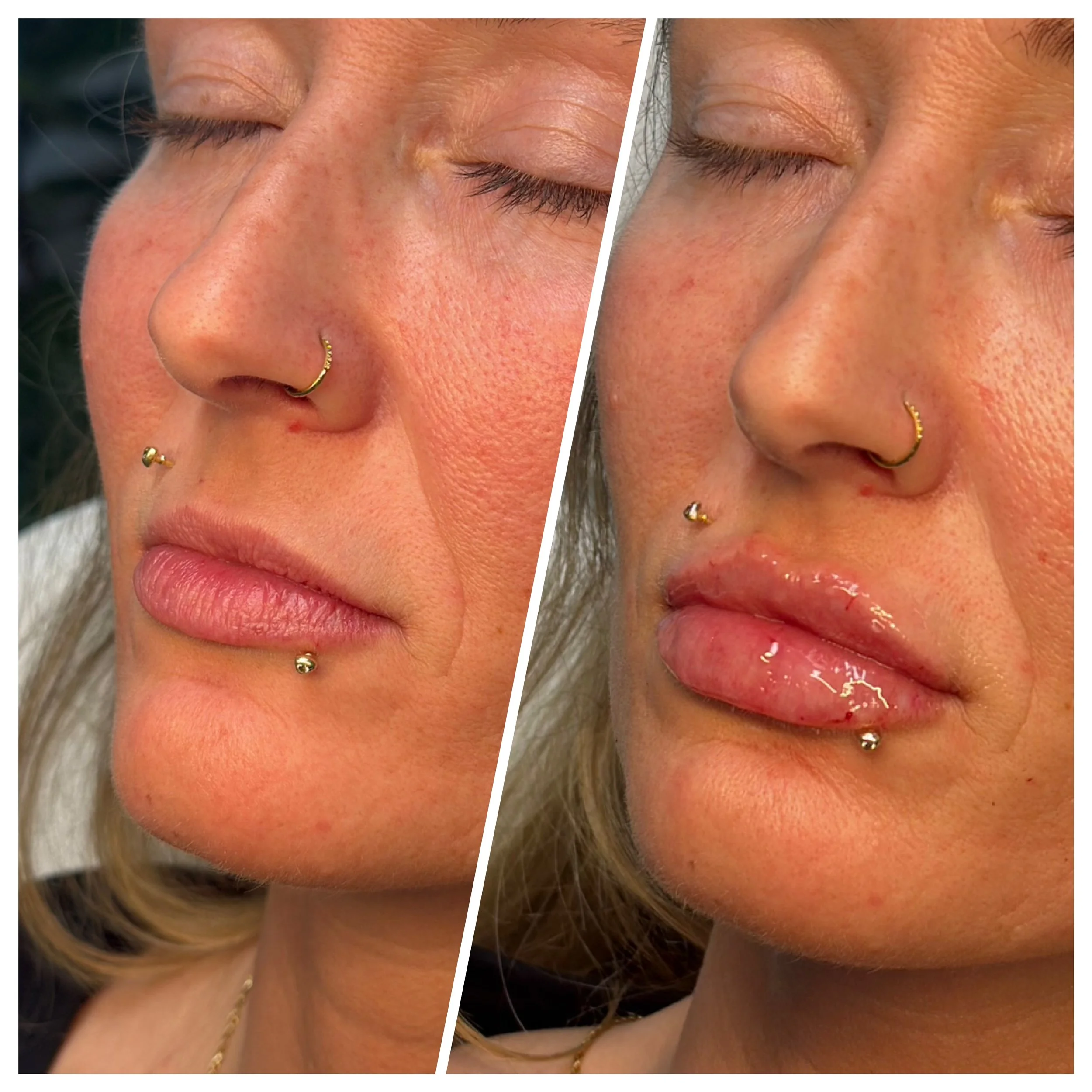 Full syringe lip filler before and after results at RAW Rejuvenation Chambersburg PA.