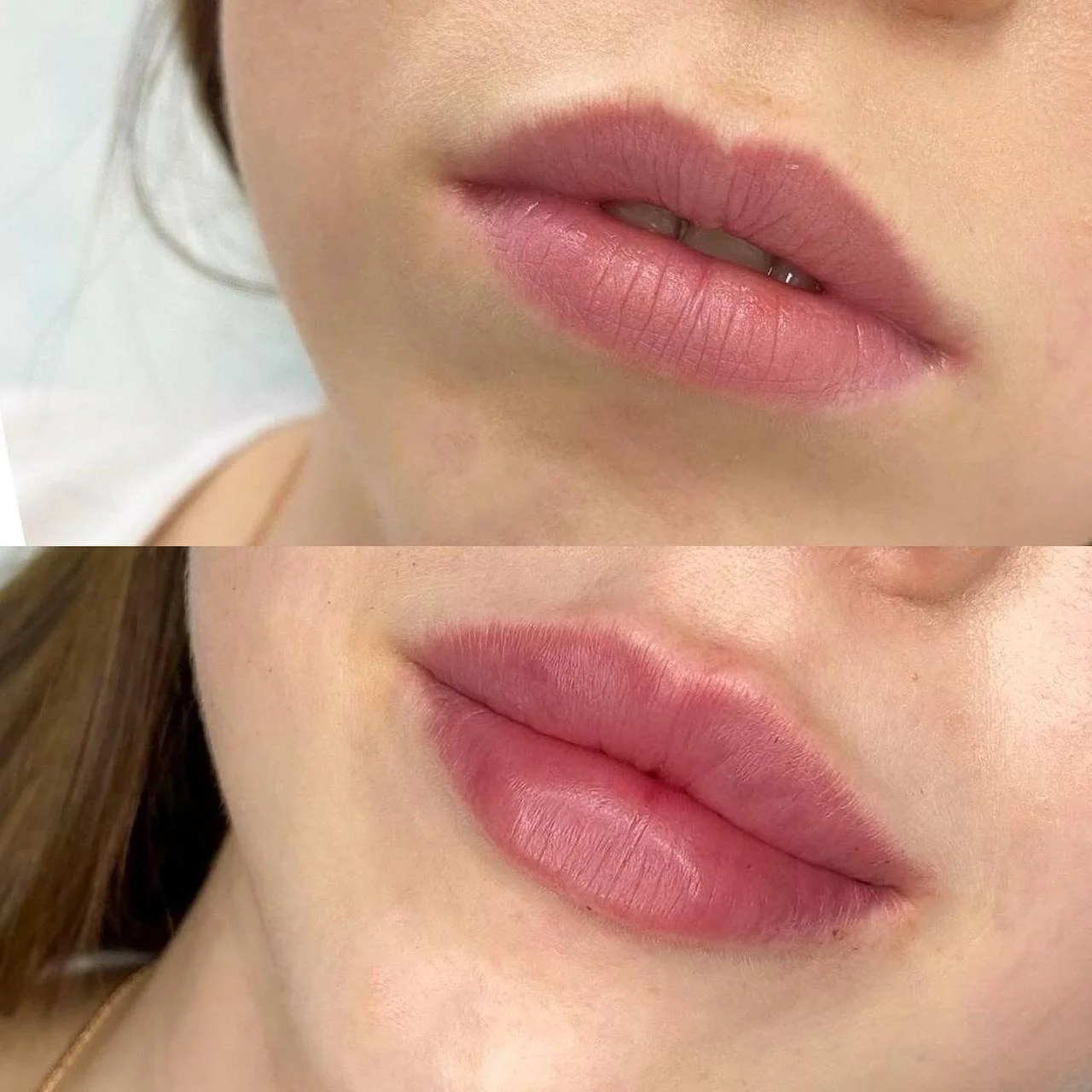 Close-up of woman's lips before and after cosmetic enhancement, showing fuller lips in the bottom image.