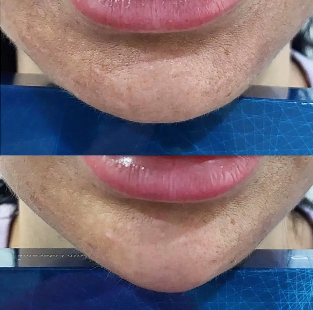 Close-up of a person's lips and chin, with the lower part of the face showing. The person has pink lips and skin with visible pores and light facial hair.