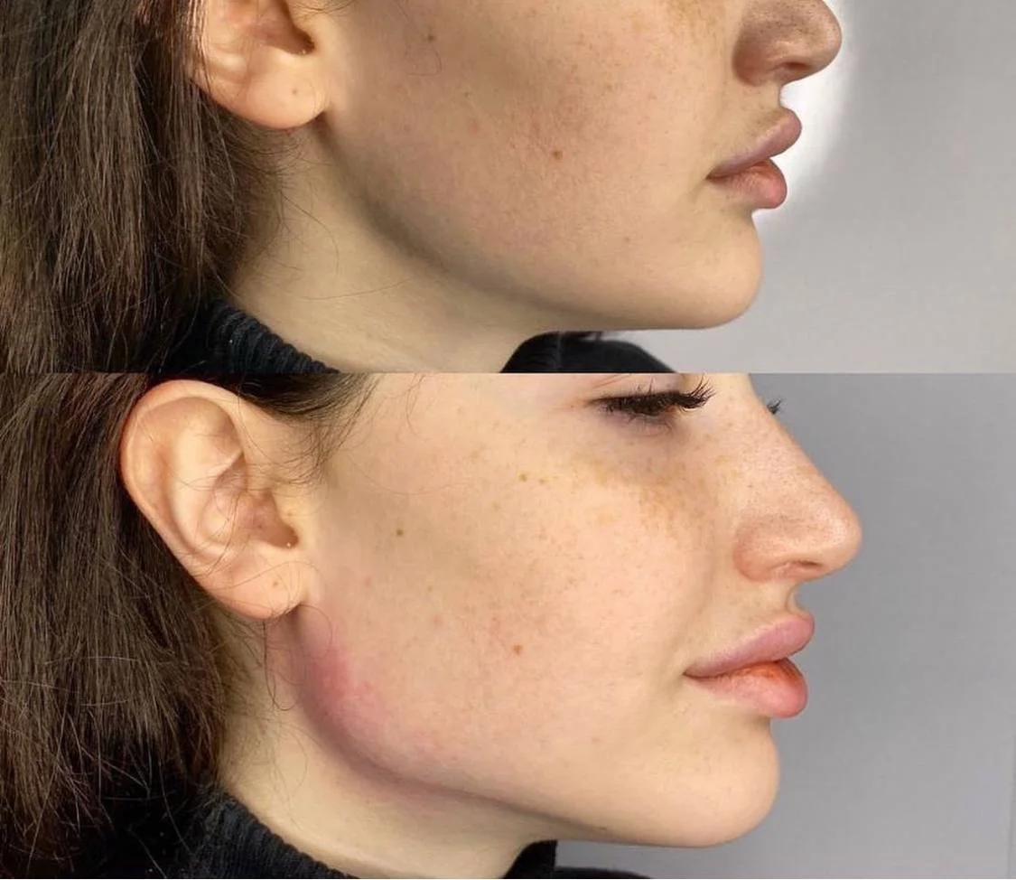 Side-by-side comparison of a woman's face before and after skincare or treatment, showing improved skin condition and reduced redness.
