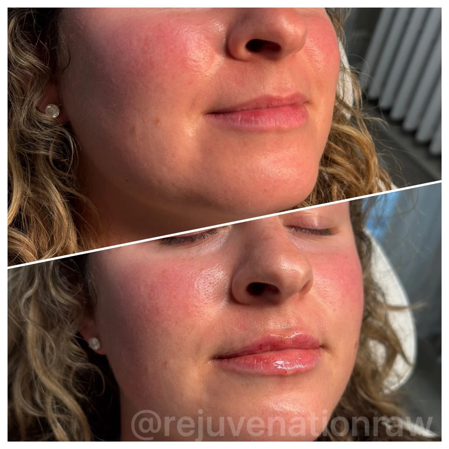 ˗ˏˋ the mini lip ˎˊ˗

I am such a fan of the &ldquo;less is more&rdquo; approach. For this session, we went with a mini lip enhancement to focus on soft, natural volume. The goal is always to define the shape and create a beautiful balance without ev
