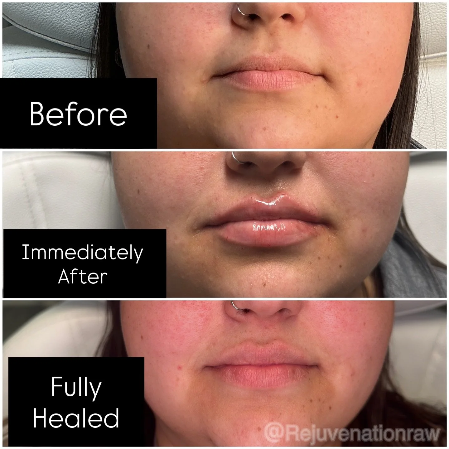 Here&rsquo;s a before and after Fully healed 😍🫦

.
.
.
.
Nichole Boland, RN ♡ 💉
RAW Rejuvenation Aesthetics &amp; Wellness ❥
📍Chambersburg, PA
Call or text: 717.913.1002 ☎️ ♡
Book online &rarr; link in bio ❦