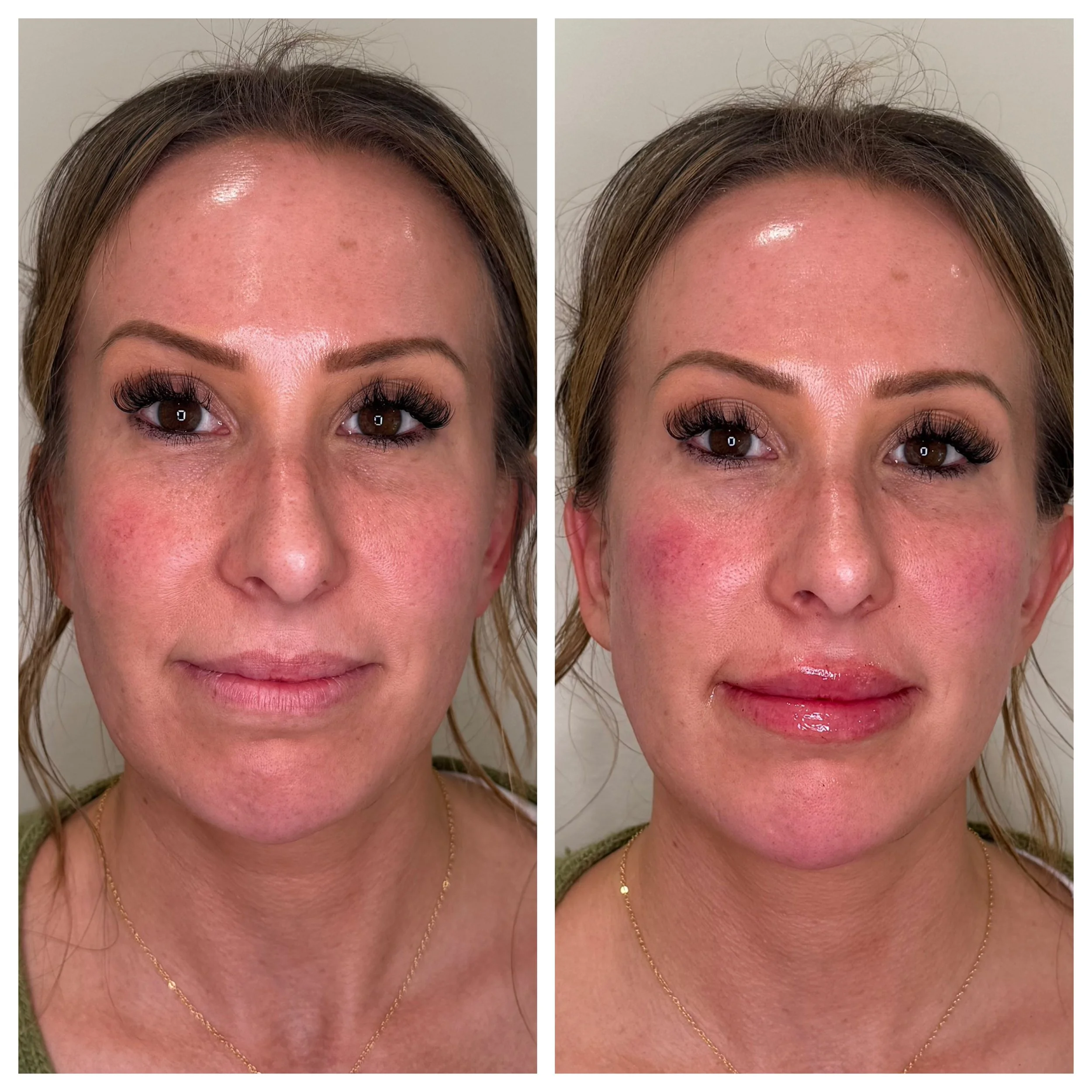 Front view before and after of a facial balancing treatment using dermal fillers to improve facial symmetry and harmony 