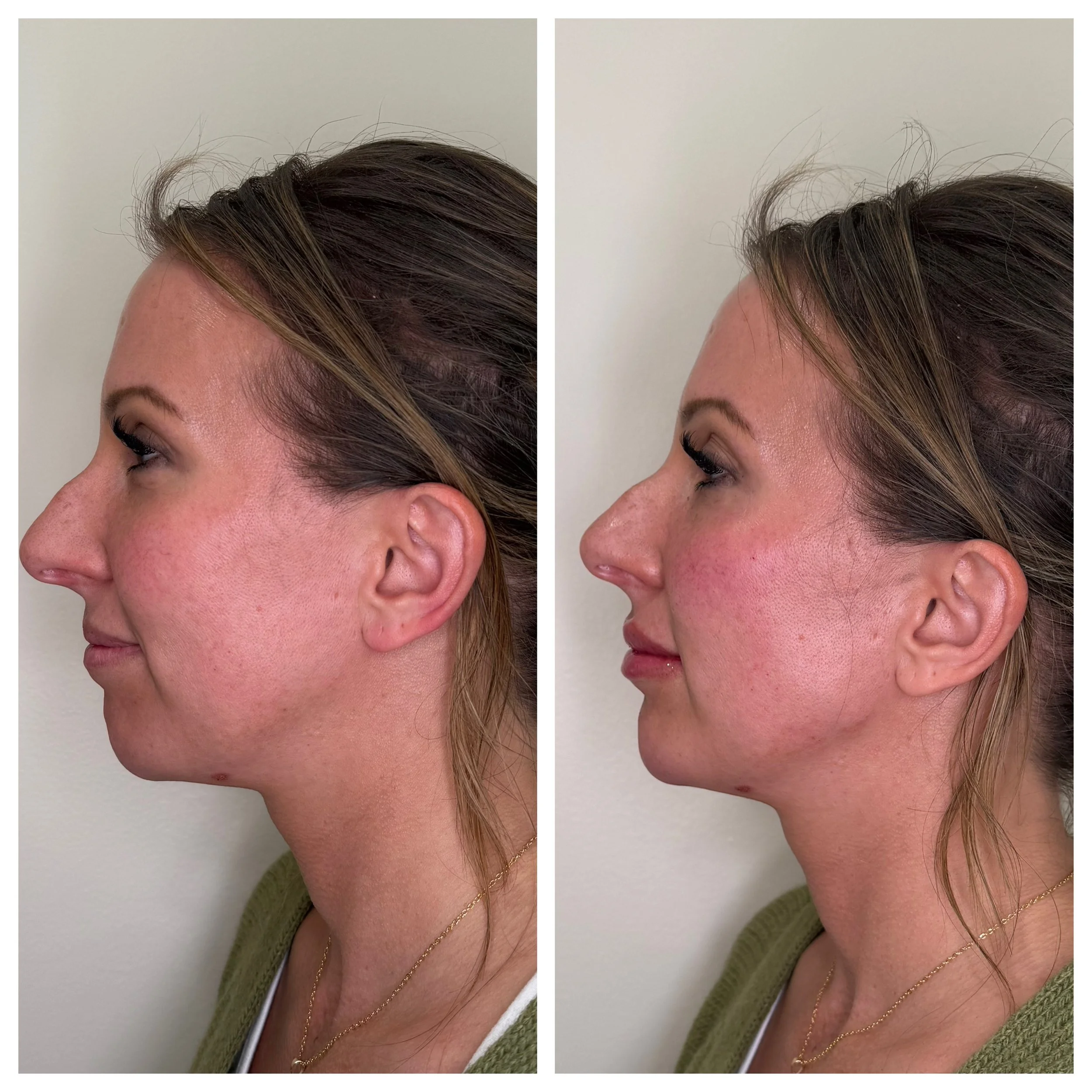 Side profile comparison of facial balancing with fillers to enhance the chin, jawline, and nose proportion for a balanced look.