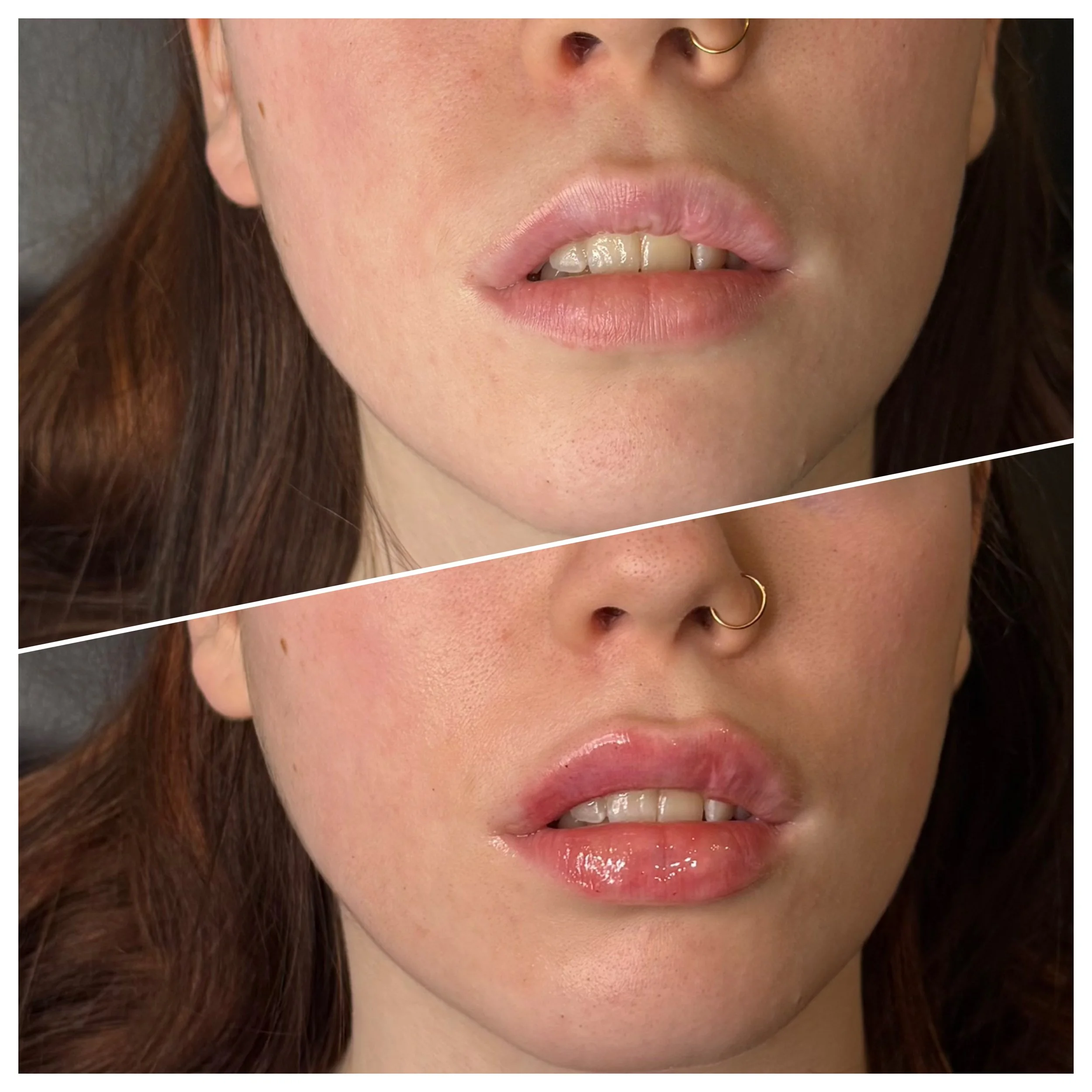 Natural lip hydration and subtle volume using Revanesse filler in Chambersburg Pennsylvania.