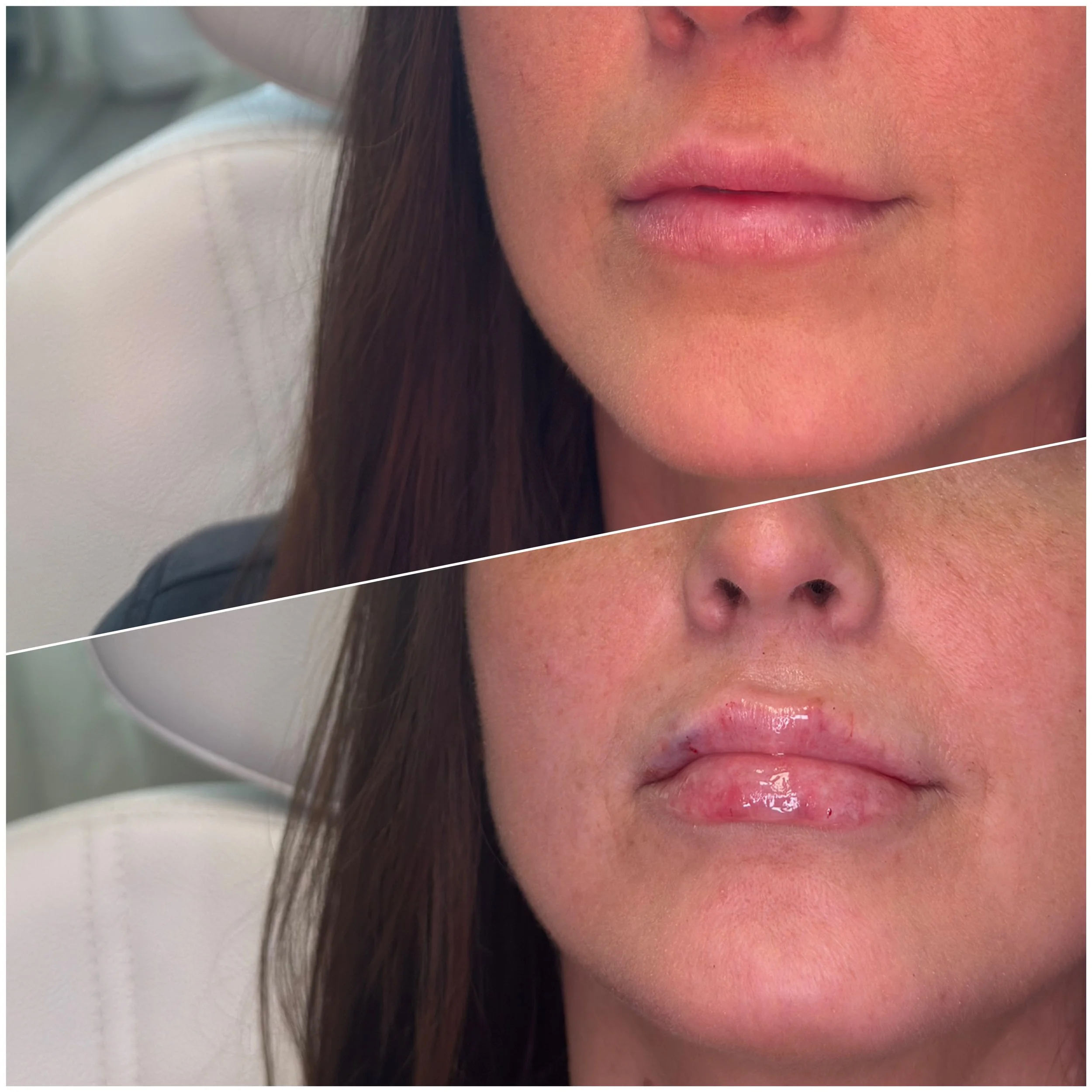Natural lip hydration and subtle volume using Revanesse filler in Chambersburg Pennsylvania.