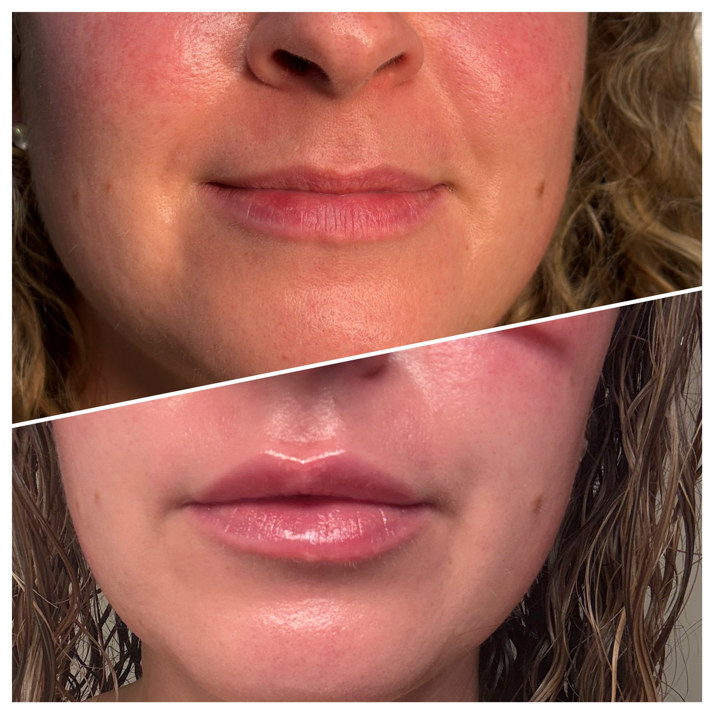 Natural lip hydration and subtle volume using Revanesse filler in Chambersburg Pennsylvania.