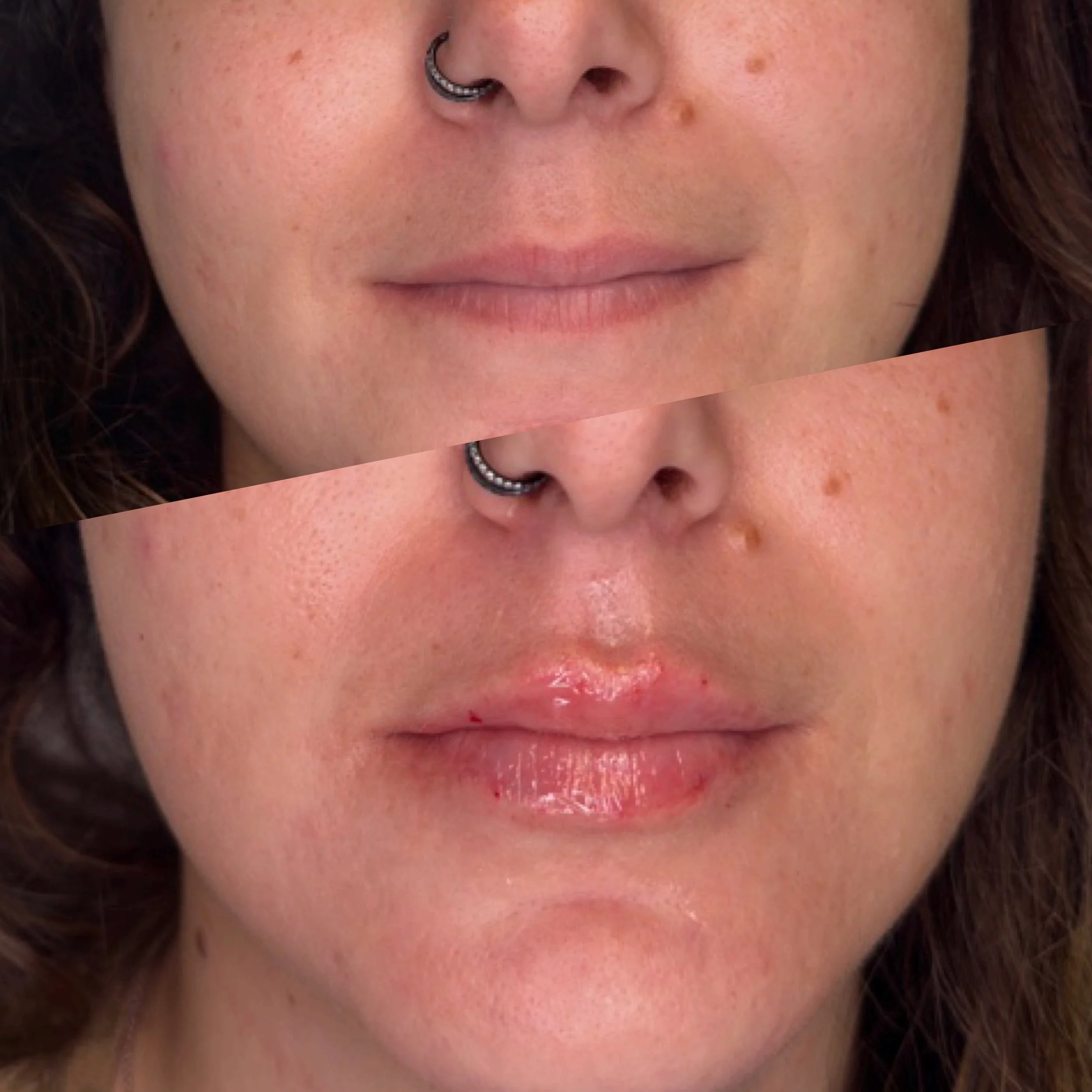 Lip injection before and after showing natural mini lip filler volume and lip line definition