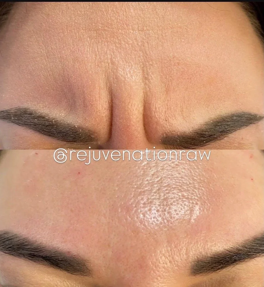 Botox before and after forehead wrinkles Chambersburg PA.