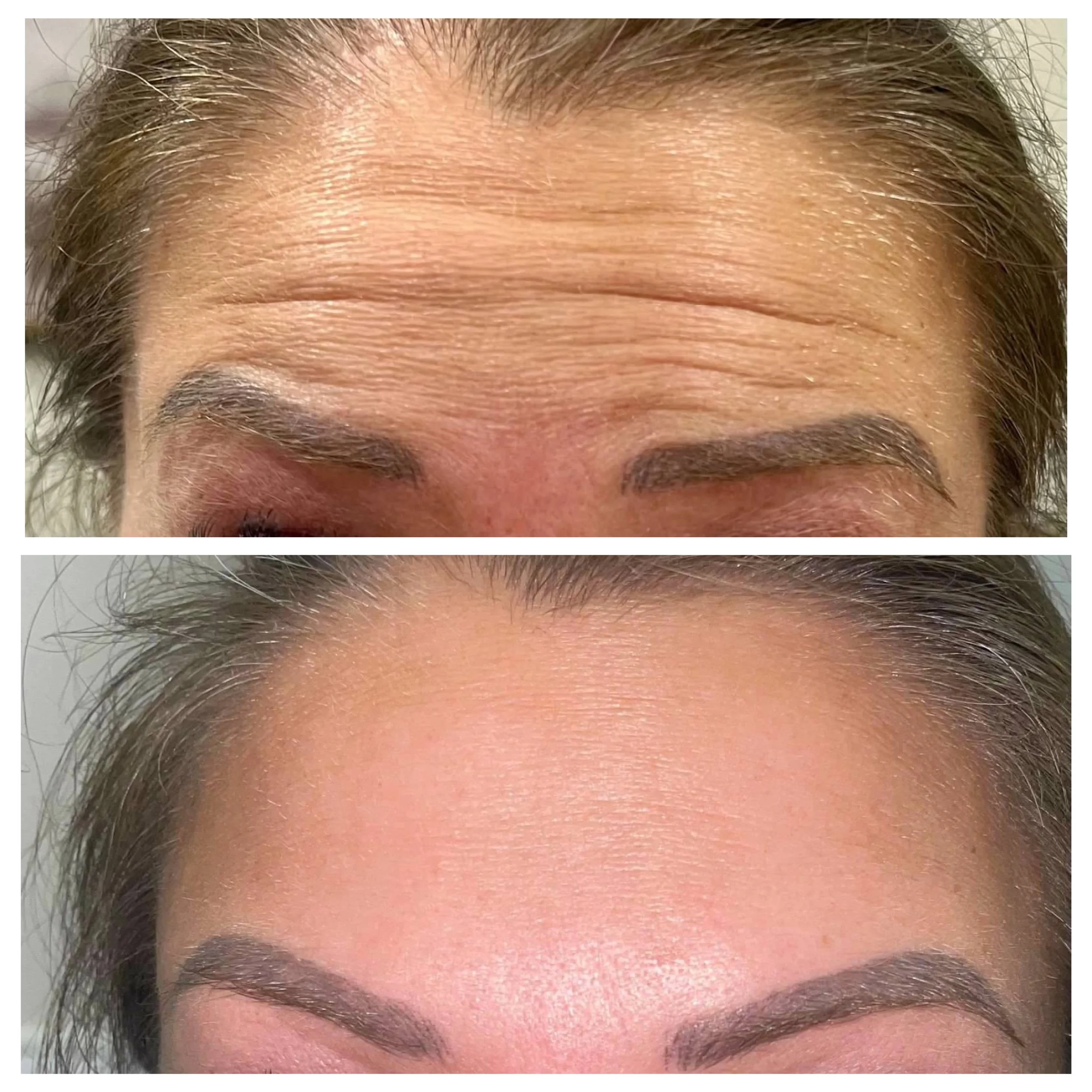 Botox before and after forehead wrinkles Chambersburg PA.