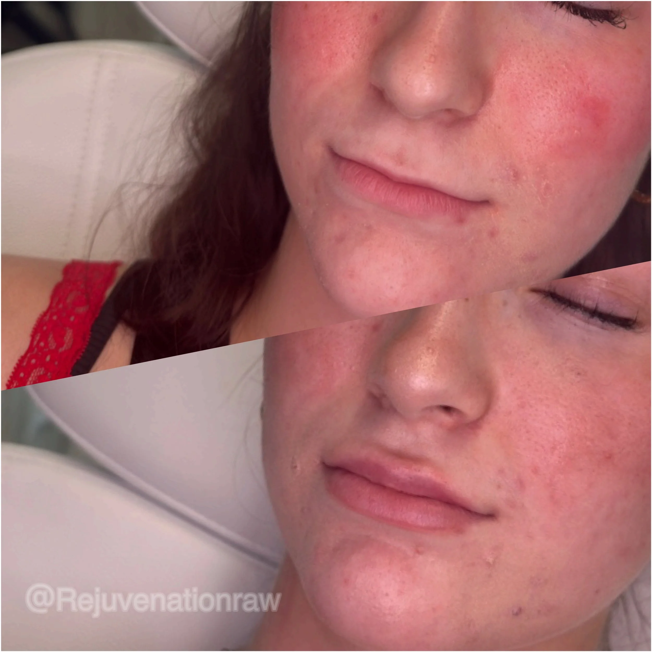 Natural mini lip plumping before and after dermal filler treatment at Chambersburg med spa