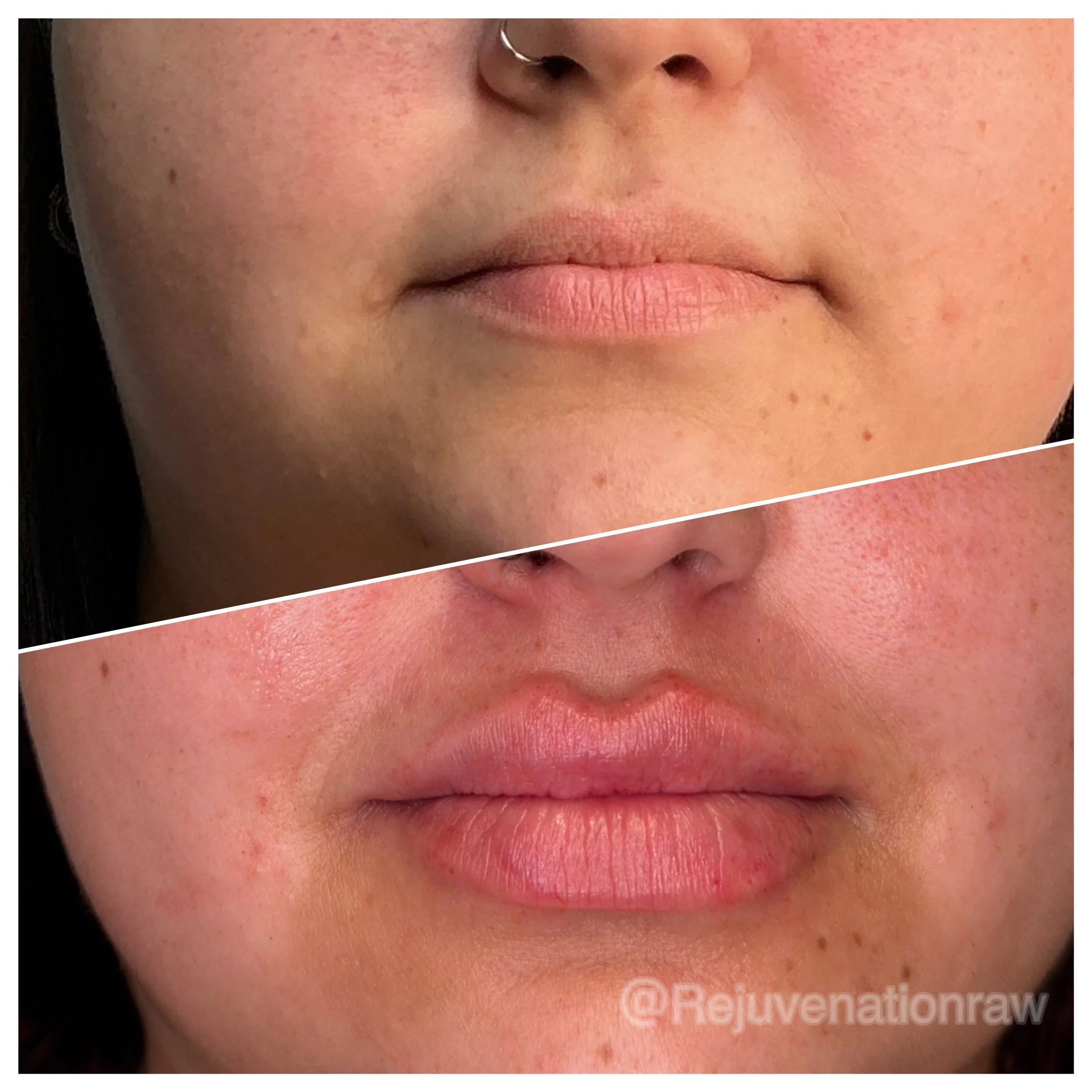 Natural lip hydration and subtle volume using Revanesse filler in Chambersburg Pennsylvania.
