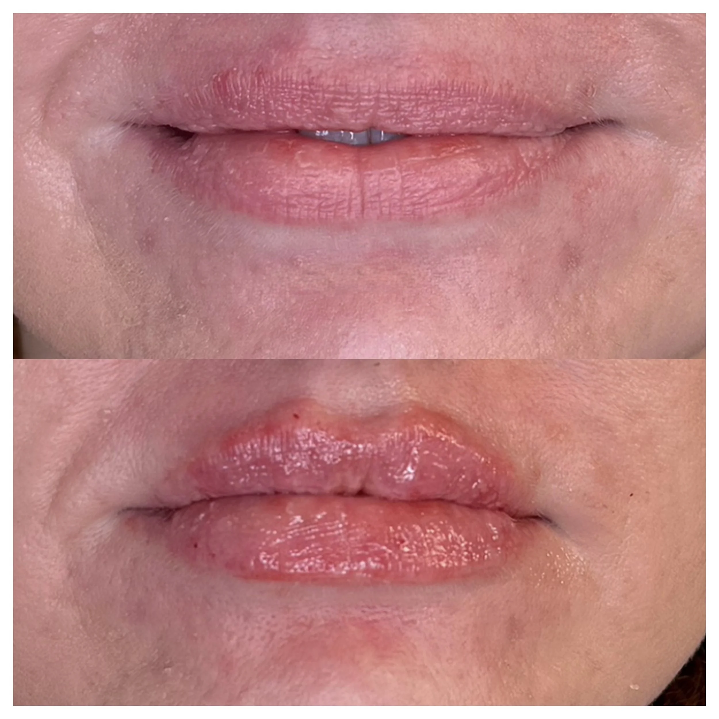 Natural lip hydration and subtle volume using Revanesse filler in Chambersburg Pennsylvania.