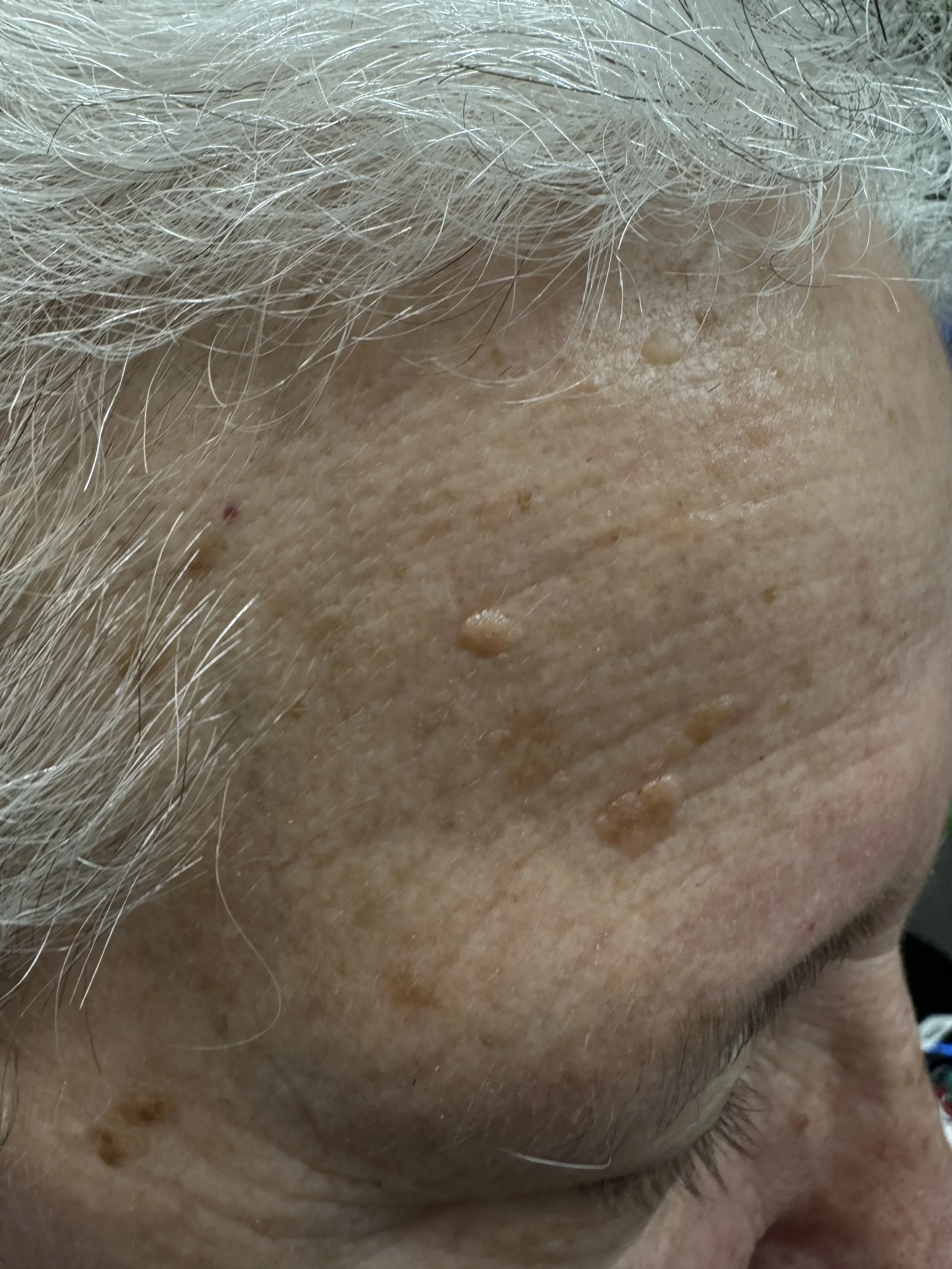 Non-surgical skin lesion removal in Medford Oregon