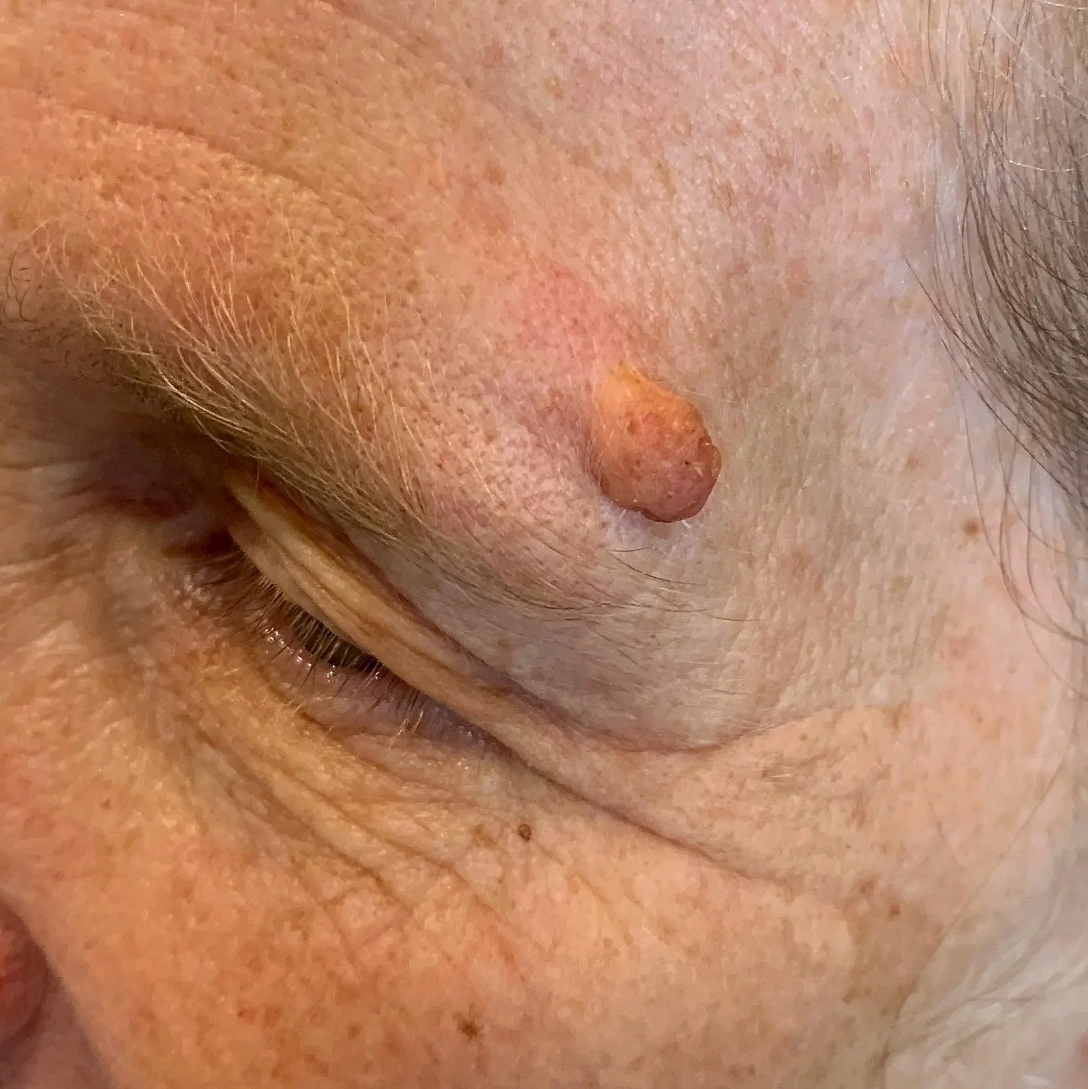 Non-surgical skin lesion removal in Medford Oregon