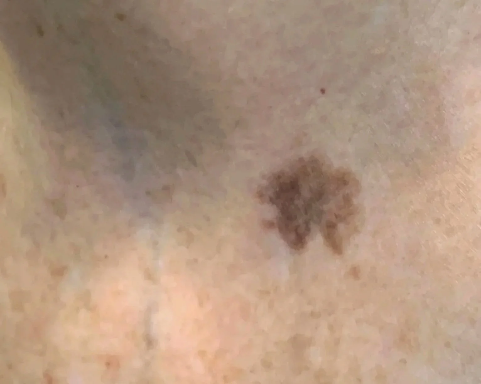 Non-surgical skin lesion removal in Medford Oregon