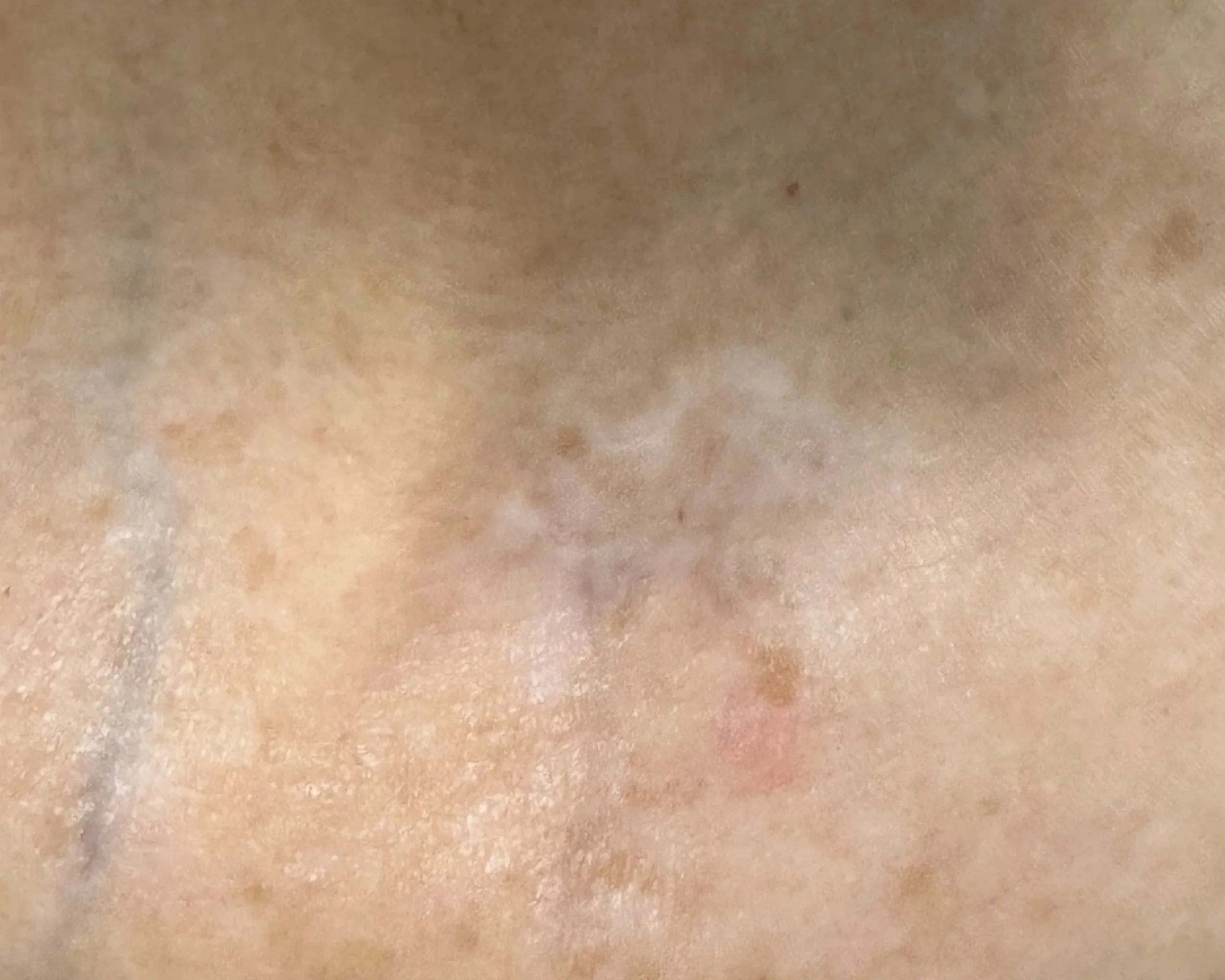 Non-surgical skin lesion removal in Medford Oregon