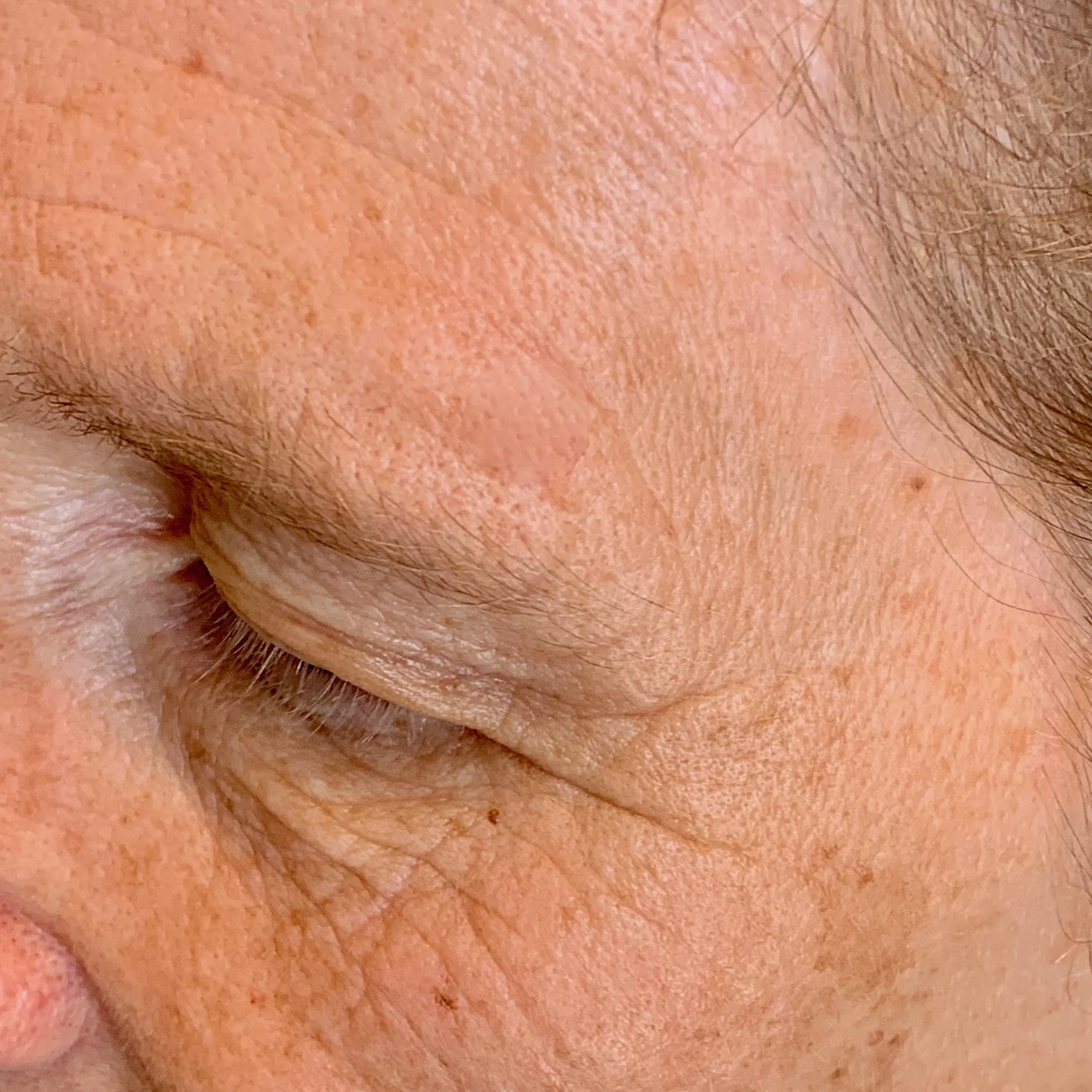 Non-surgical skin lesion removal in Medford Oregon