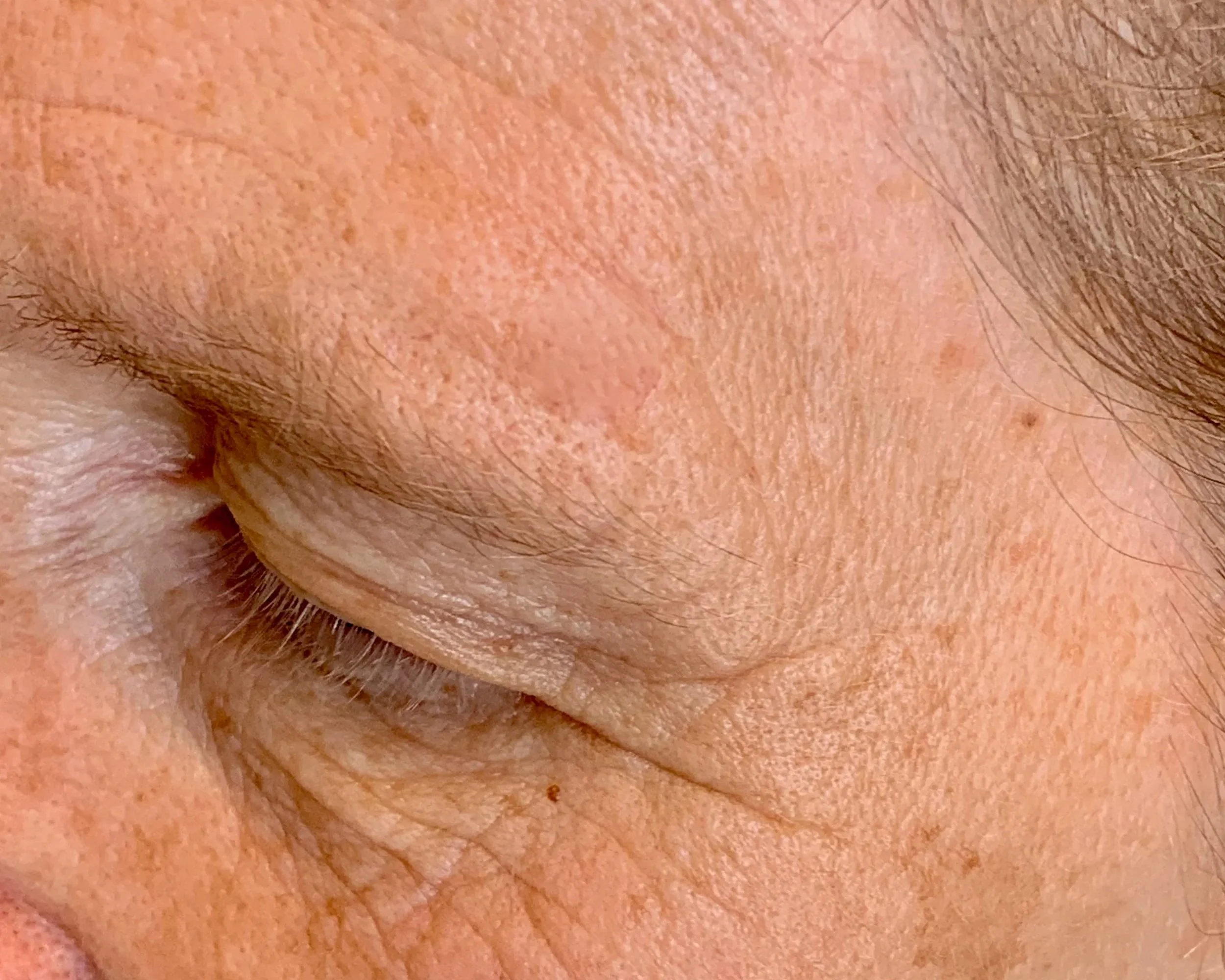 Non-surgical skin lesion removal in Medford Oregon