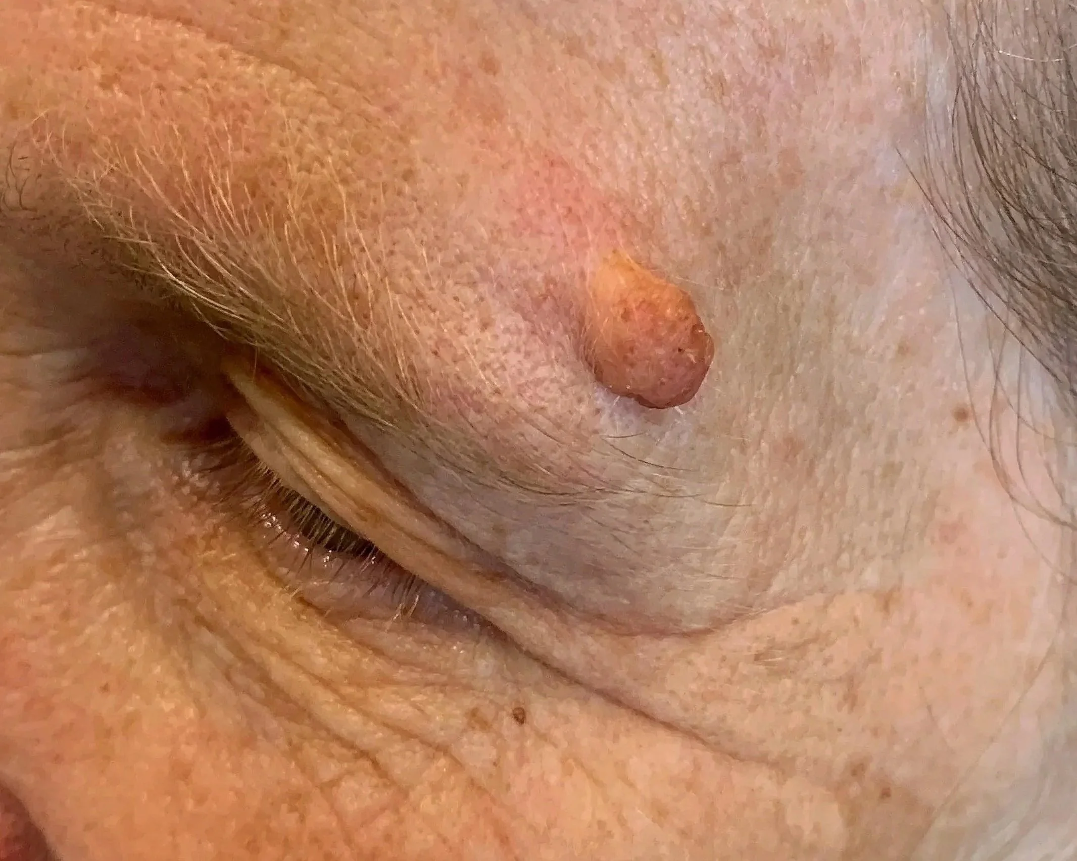 Non-surgical skin lesion removal in Medford Oregon