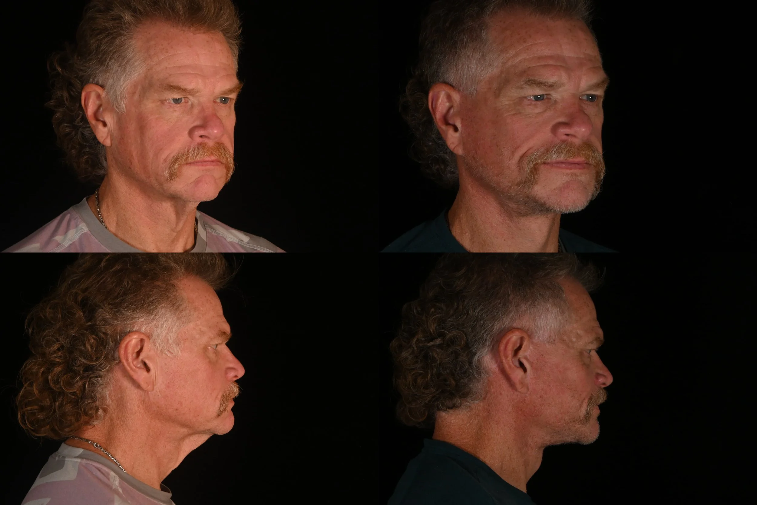 Deep plane facelift and neck lift after weight loss