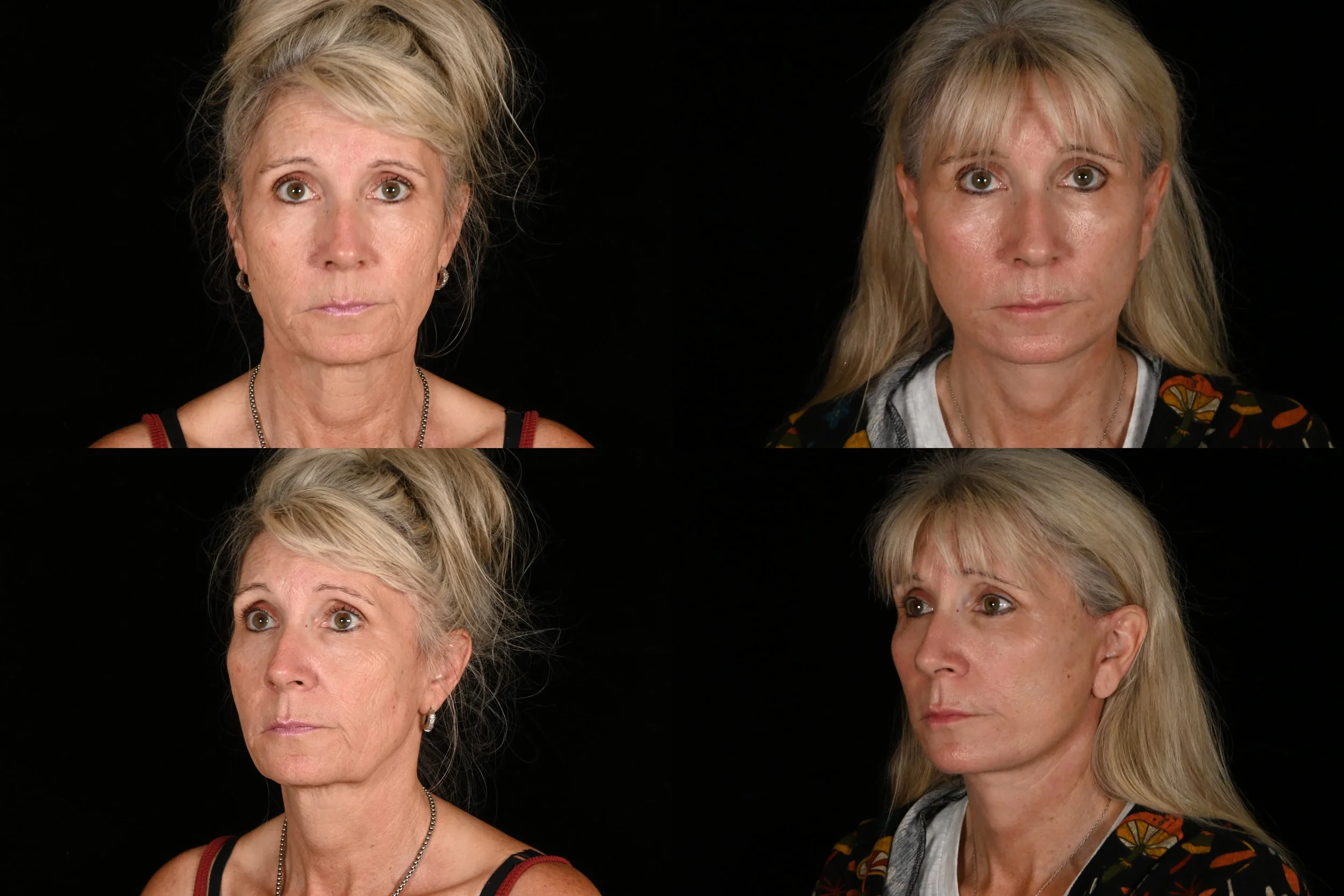 Ablative co2 laser resurfacing, brow lift, deep plane facelift and neck lift