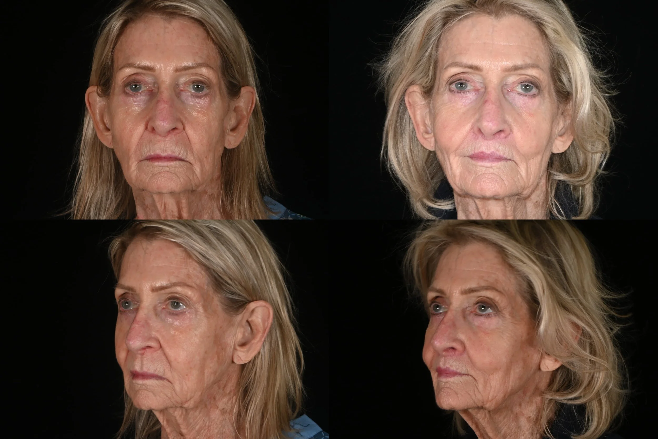 Comparison of an elderly woman with facial aging and a younger, more youthful appearance in a before-and-after photo.