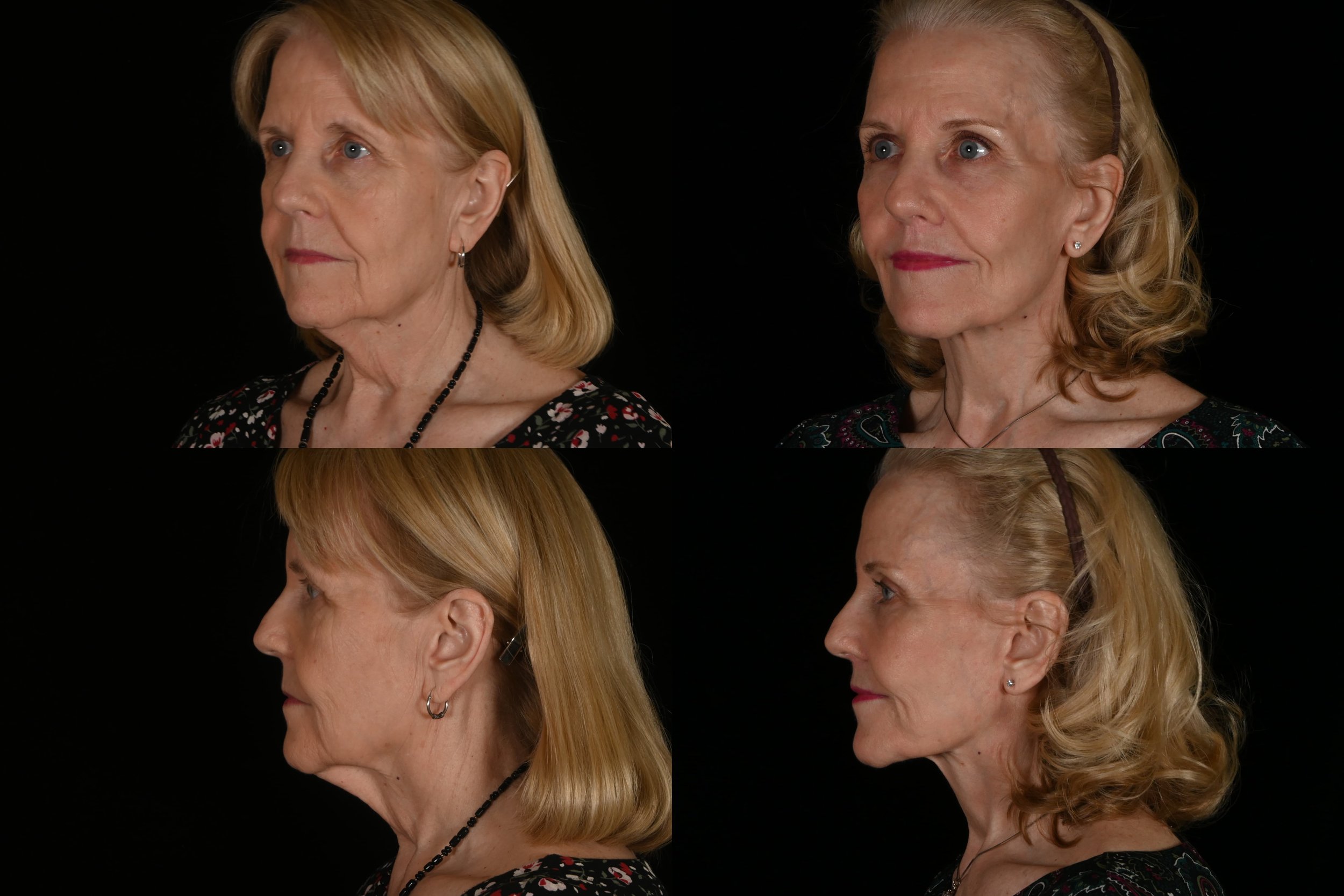 Fat grafting, ablative co2 laser resurfacing, lip lift, deep plane facelift and neck lift