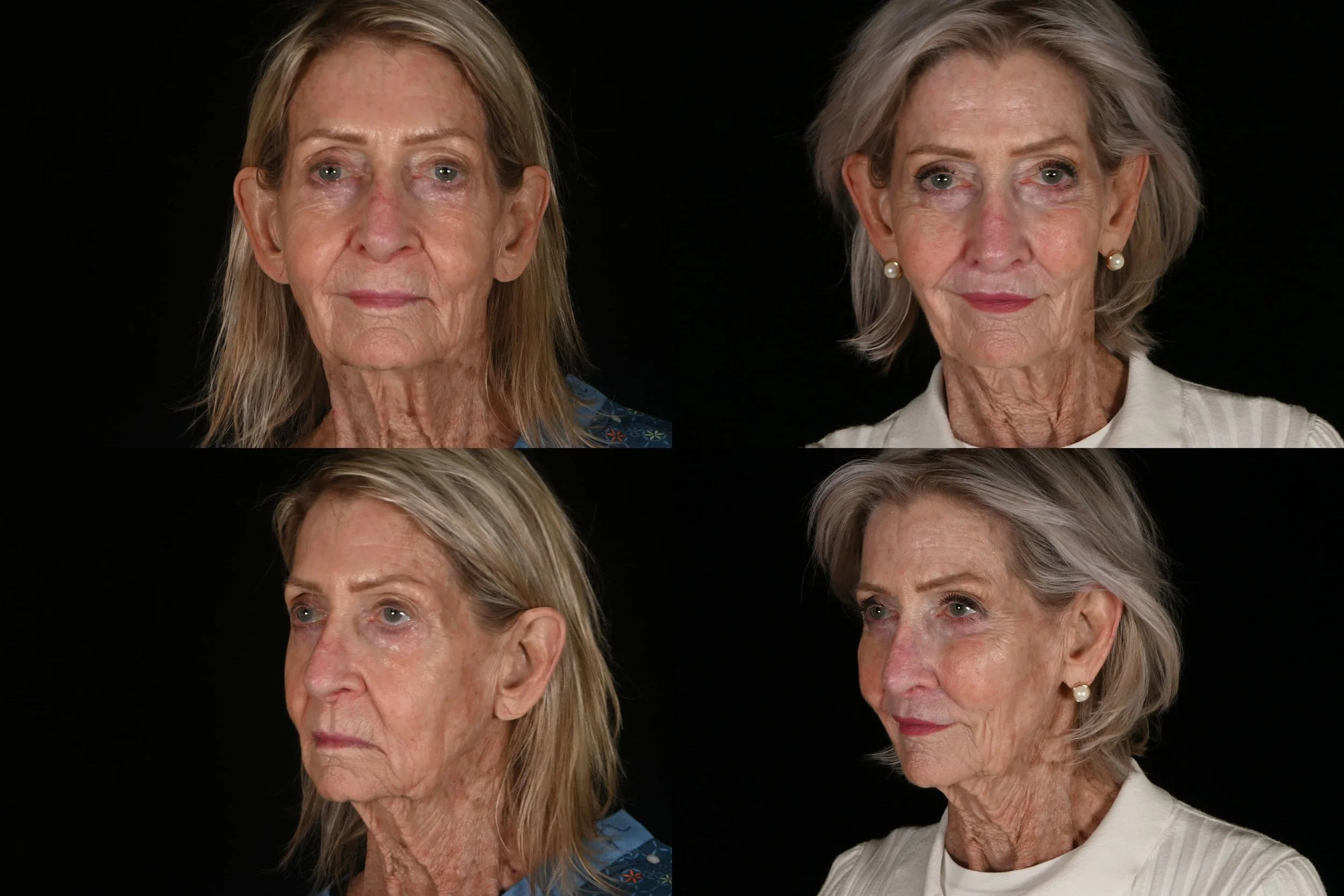 Ablative co2 laser resurfacing, hyaluronic facial filler in malor area