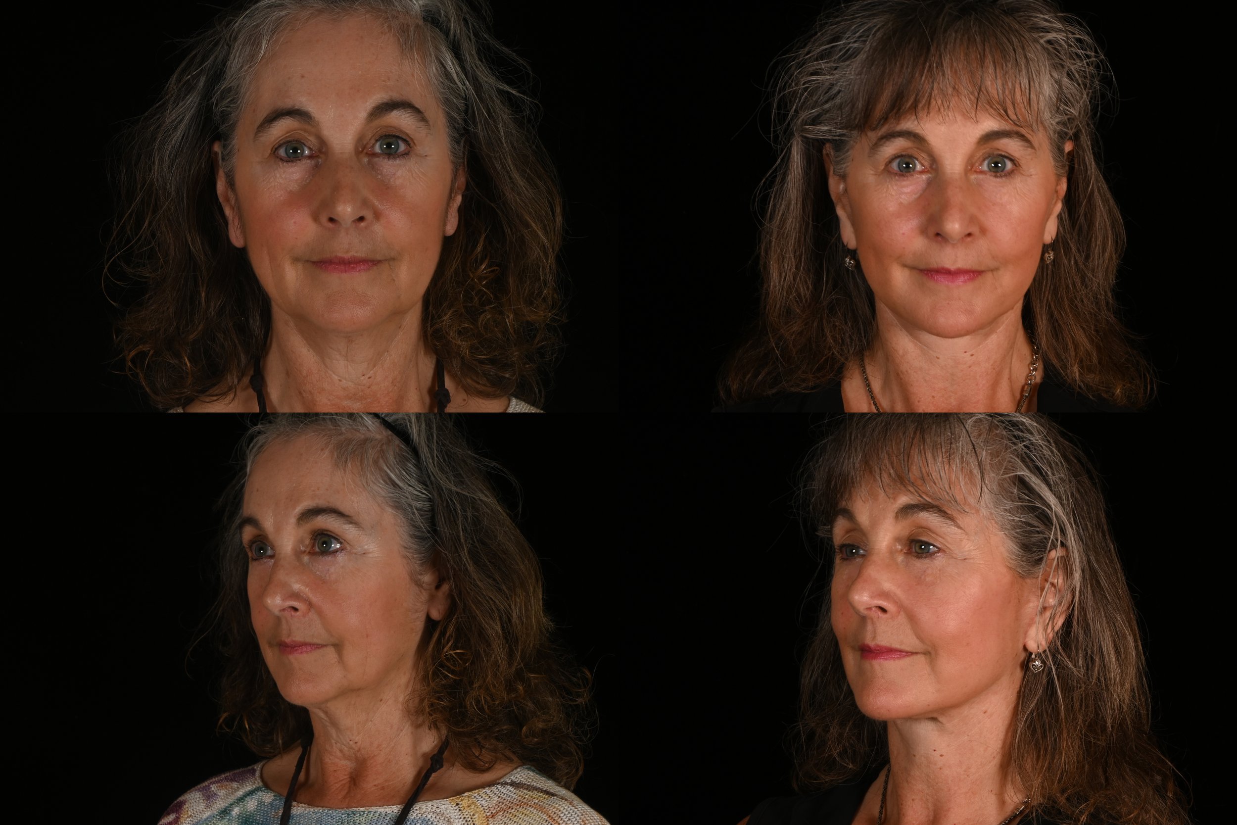 deep plane facelift neck lift fat grafting massive weight loss glp-1 brow lift upper eyelid surgery lower blepharoplasty co2 laser ablative