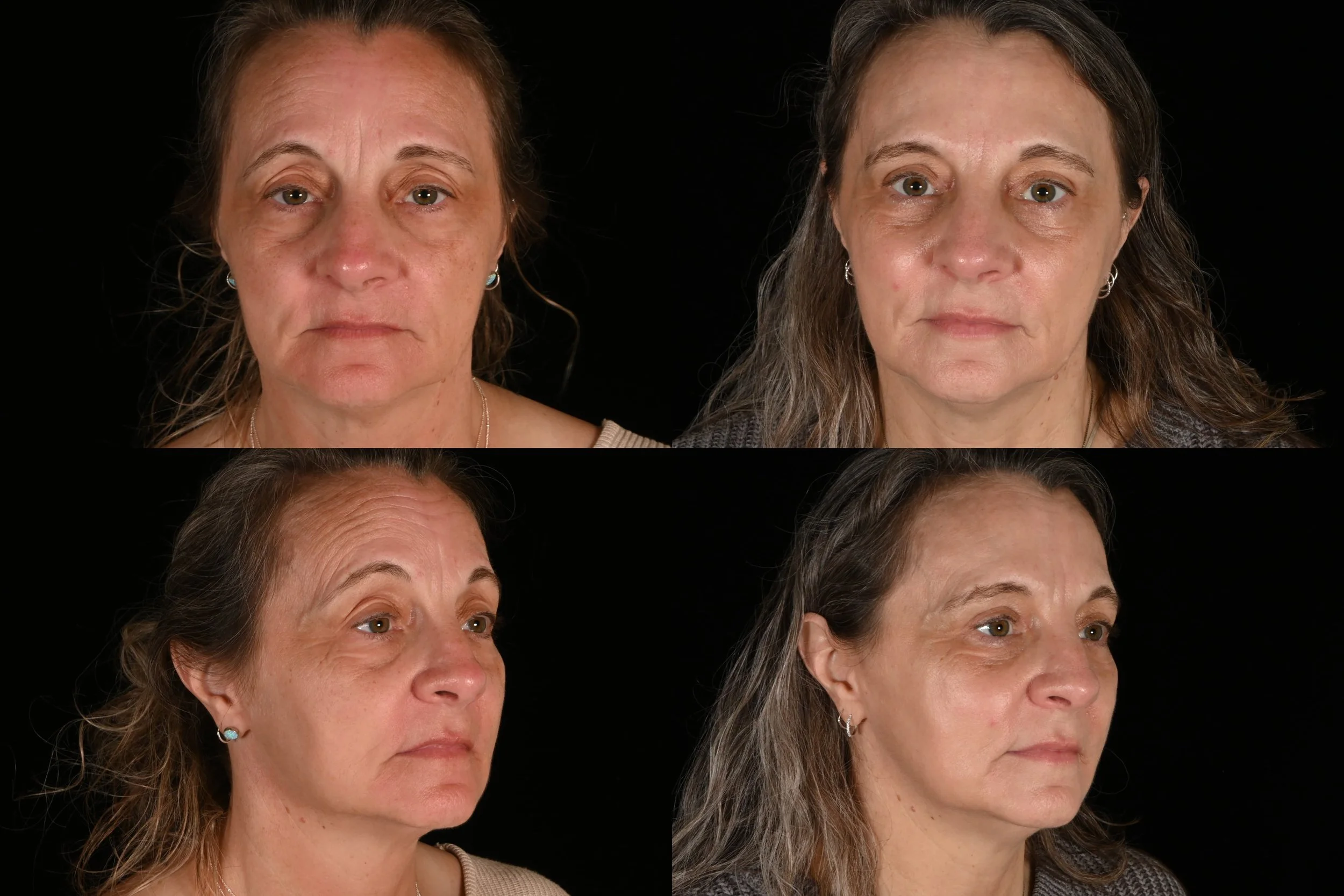 Ablative co2 laser resurfacing, upper blepharoplasty, lower blepharoplasty, brow pexy