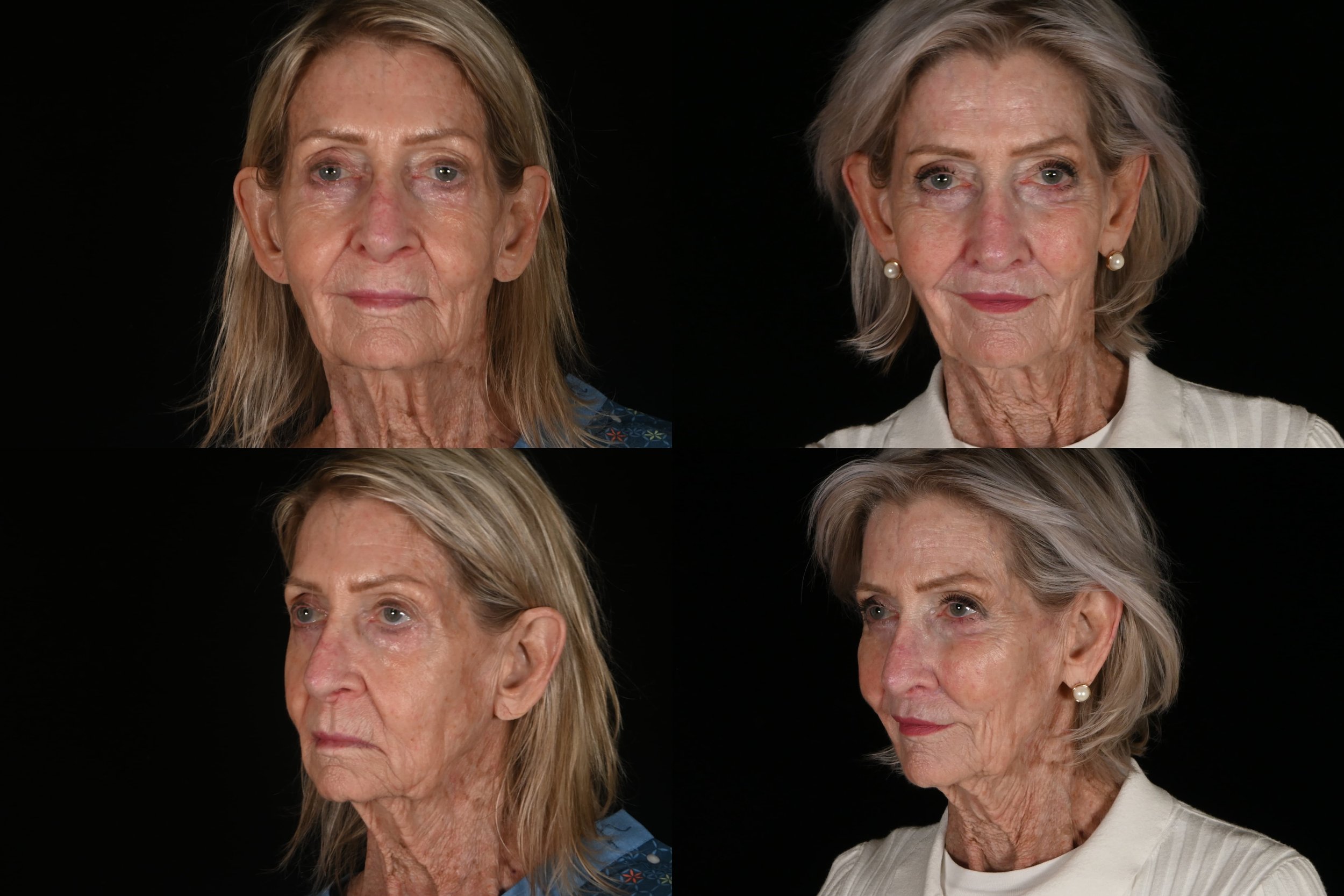 Side-by-side comparison of an elderly woman before and after a skincare treatment, shown from different angles against a black background.