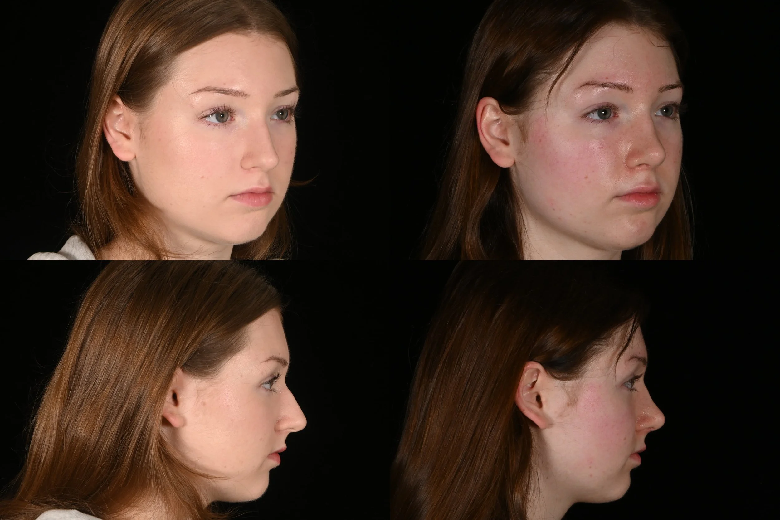 Rhinoplasty