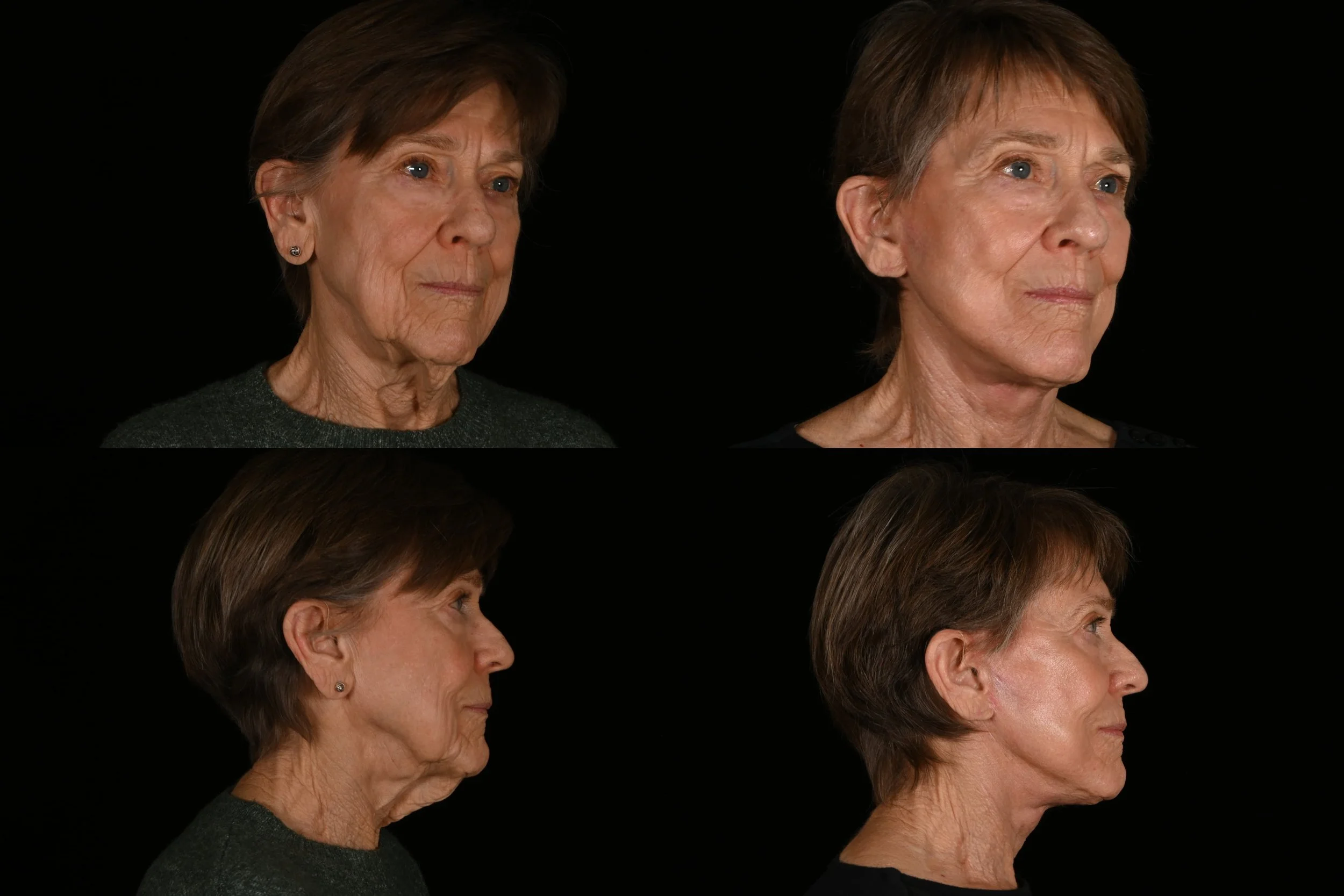 Deep plane facelift and neck lift
