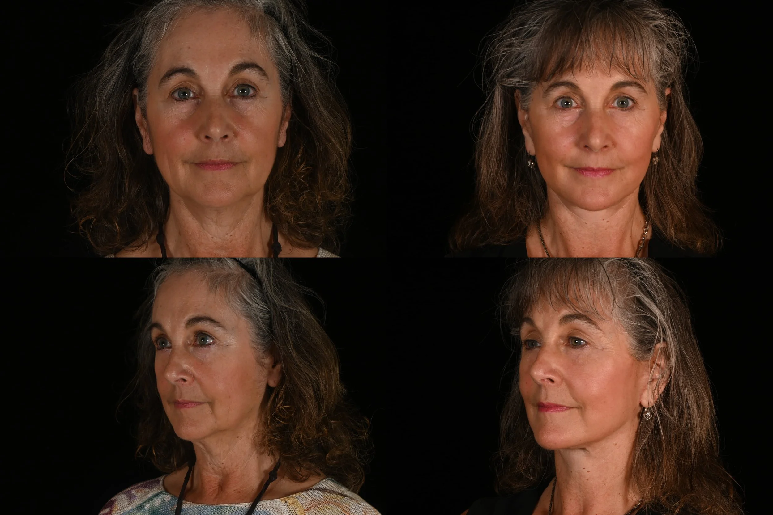 Deep plane facelift and neck lift after weight loss
