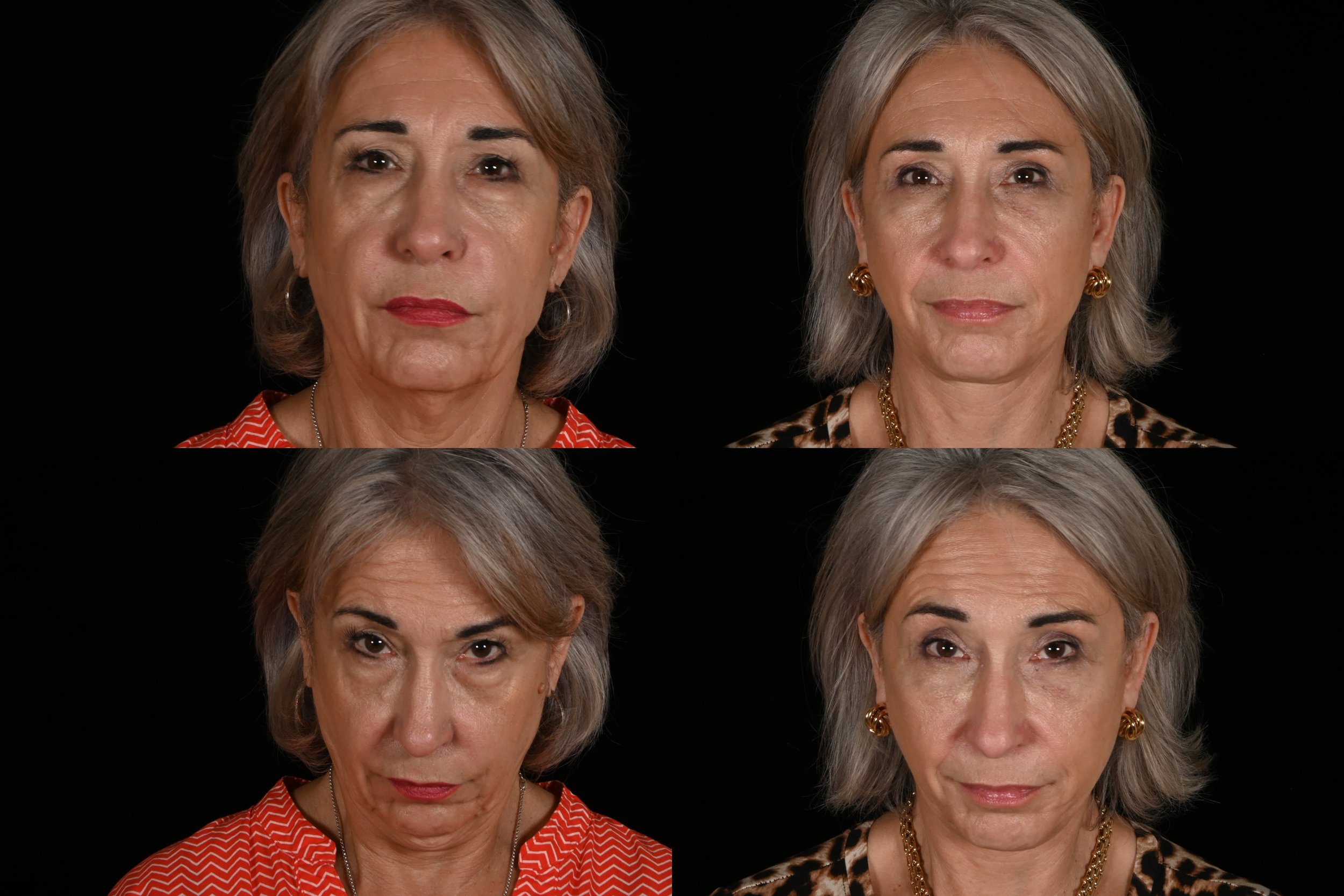 Upper blepharoplasty, lower blepharoplasty with fat grafting, deep plane face and neck lift, ablative co2 laser resurfacing