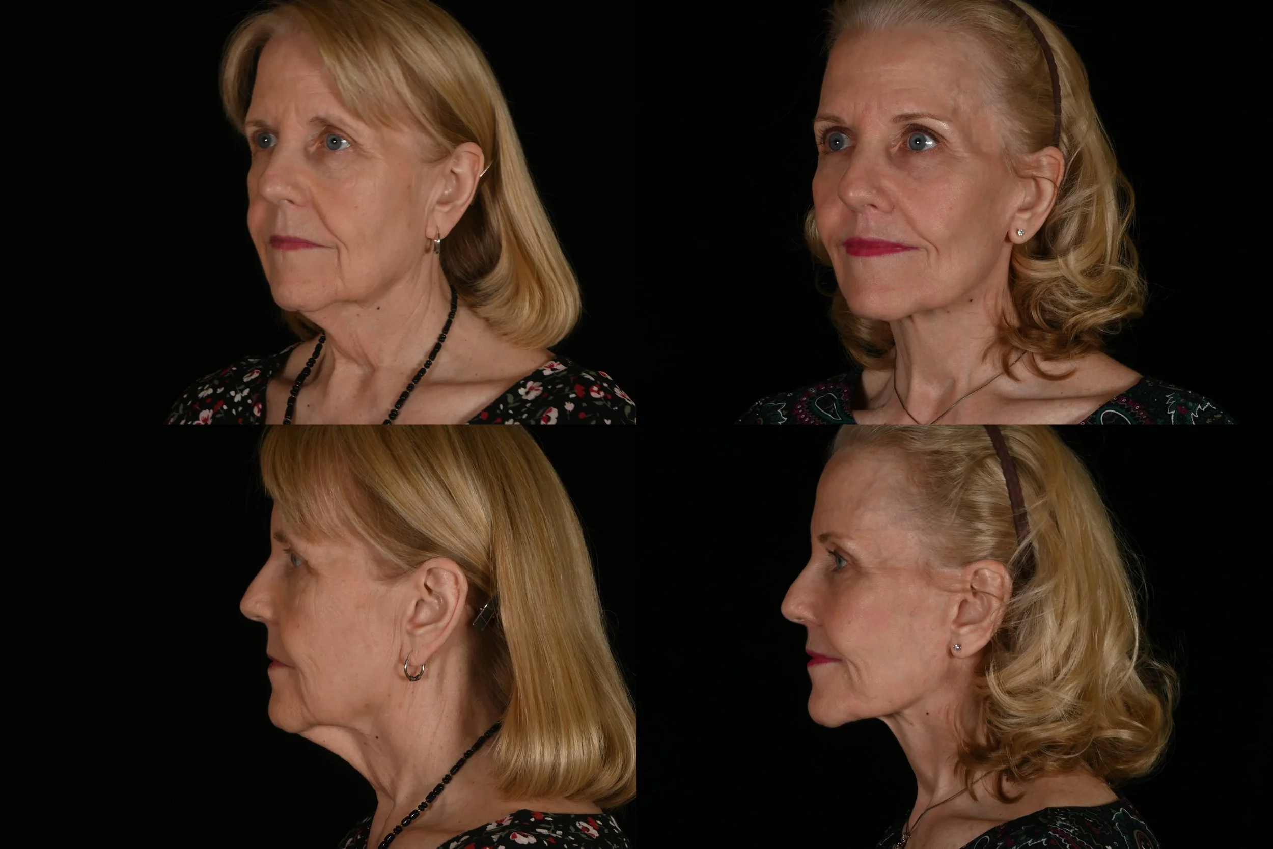 Deep plane facelift and neck lift, lip lift, brow lift, fat grafting, and laser resurfacing after weight loss