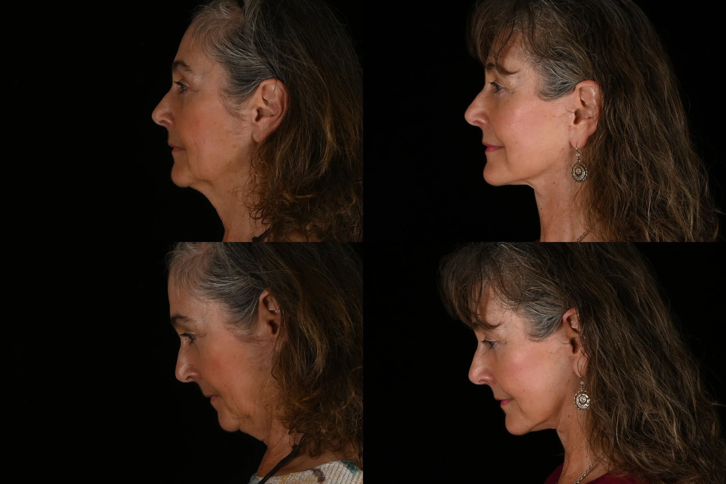 Deep plane facelift and neck after weight loss