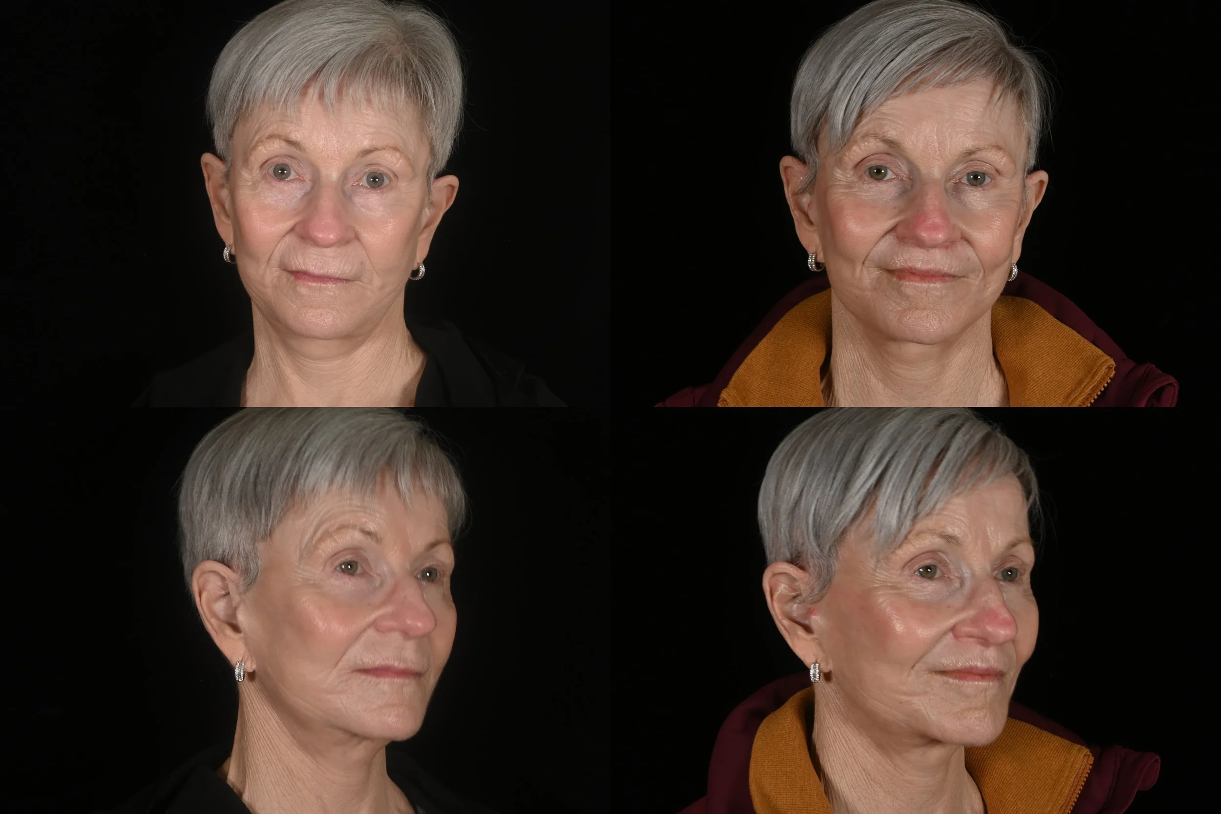 Lip lift and ablative co2 laser resurfacing