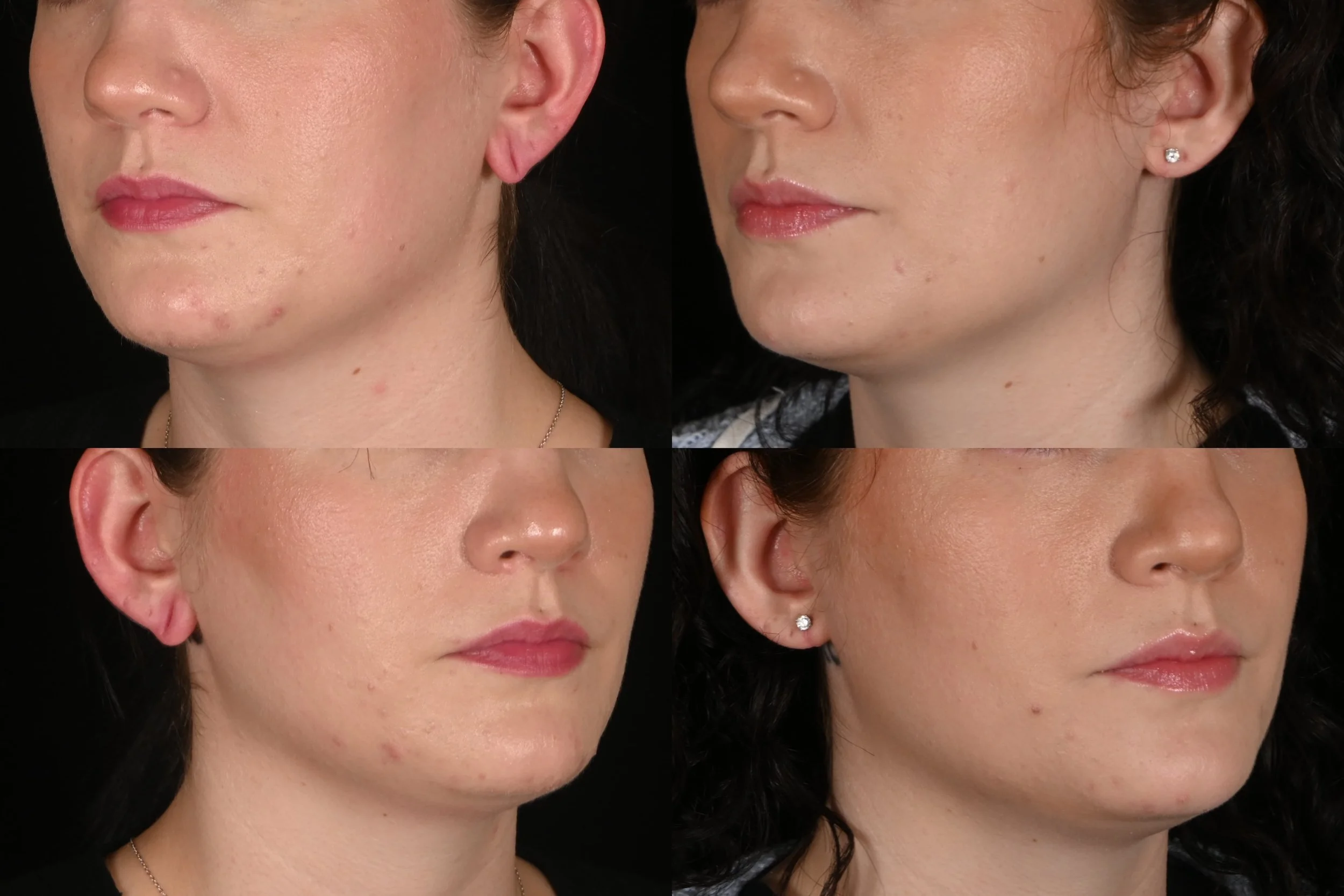 Ear lobe repair