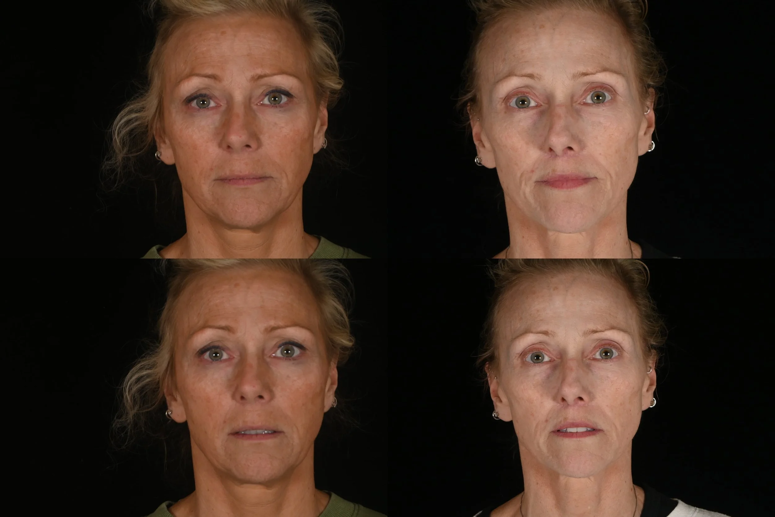Lip lift