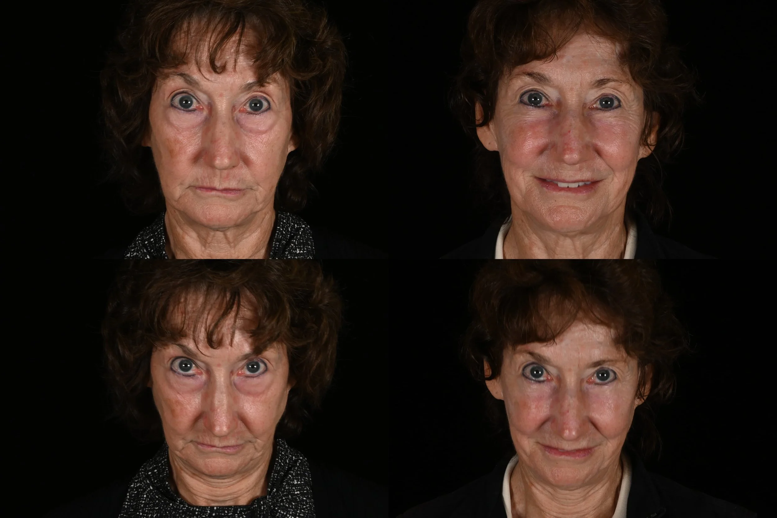 Lower blepharoplasty, fat grafting, ablative c02 laser resurfacing