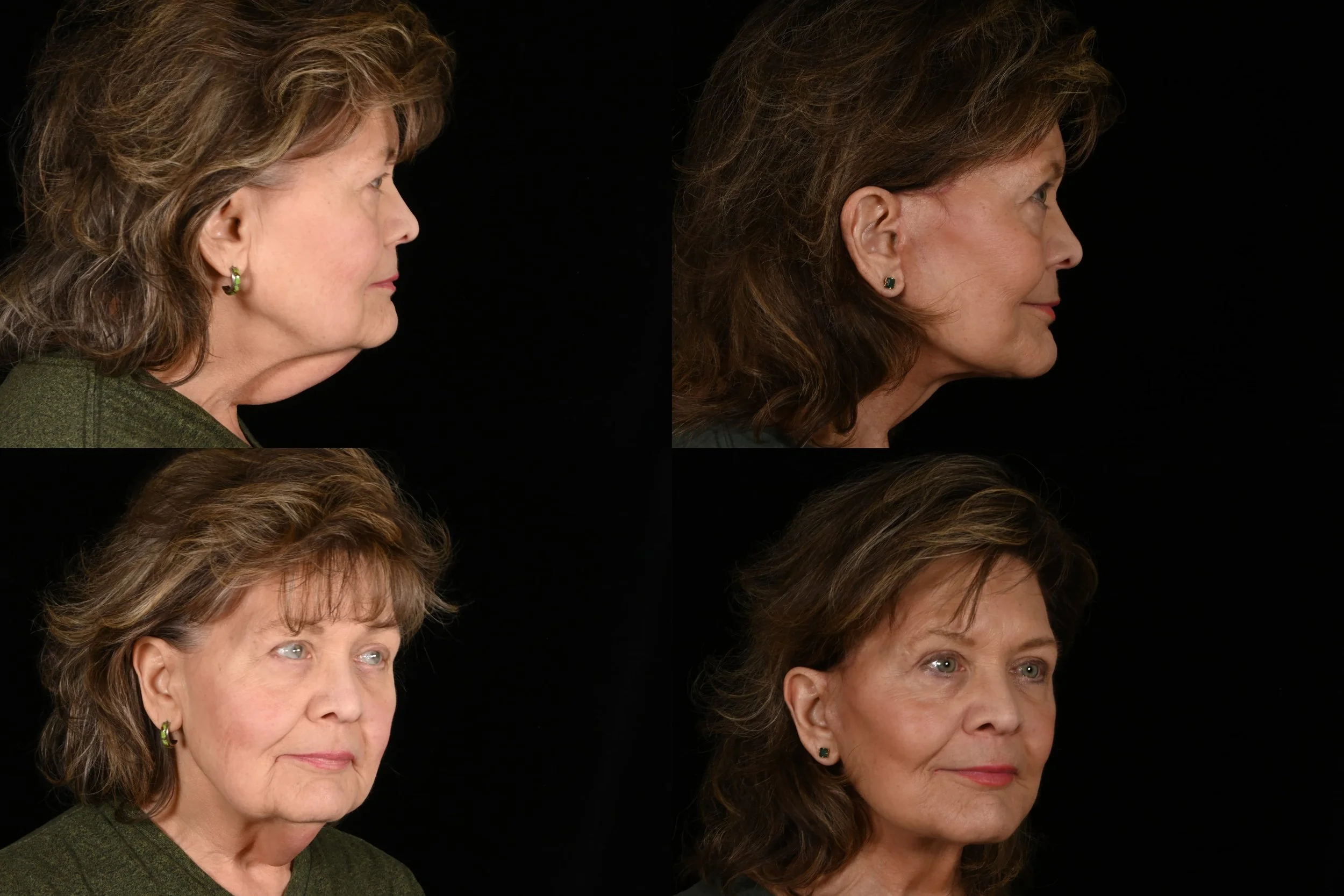 Deep plane facelift and neck lift, upper blepharoplasty, and brow pexy