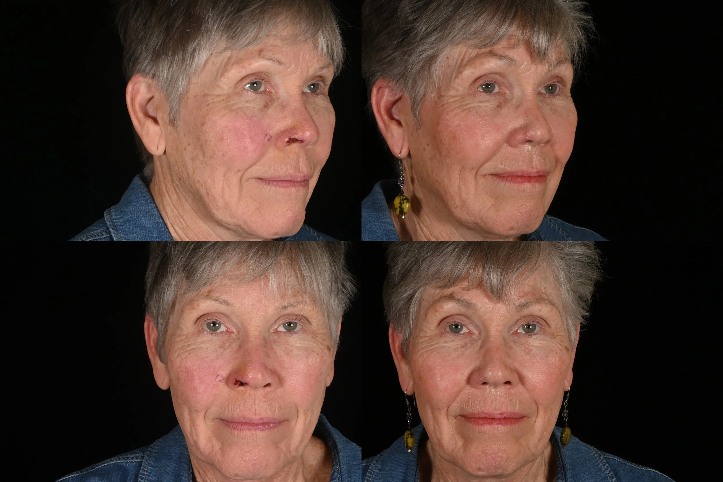 Four images of an elderly woman showing a progression of facial changes or medical treatment, with the first image showing her with some skin lesions and the last showing clear skin.