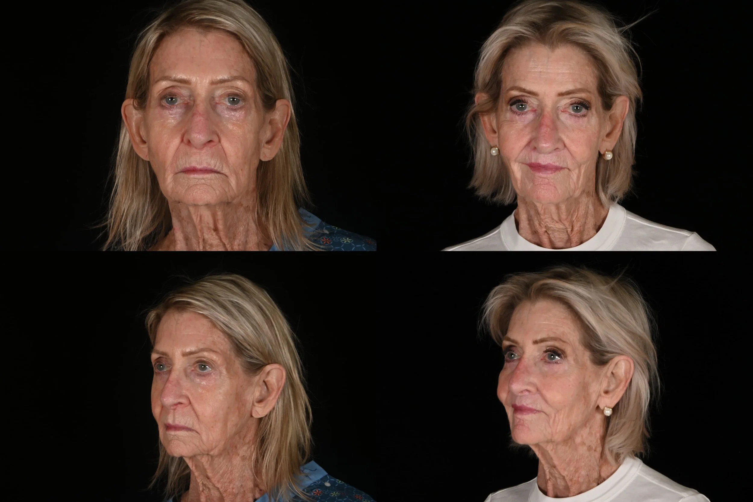 Before and after images of an elderly woman, showing the effects of makeup or skincare transformation on her face.