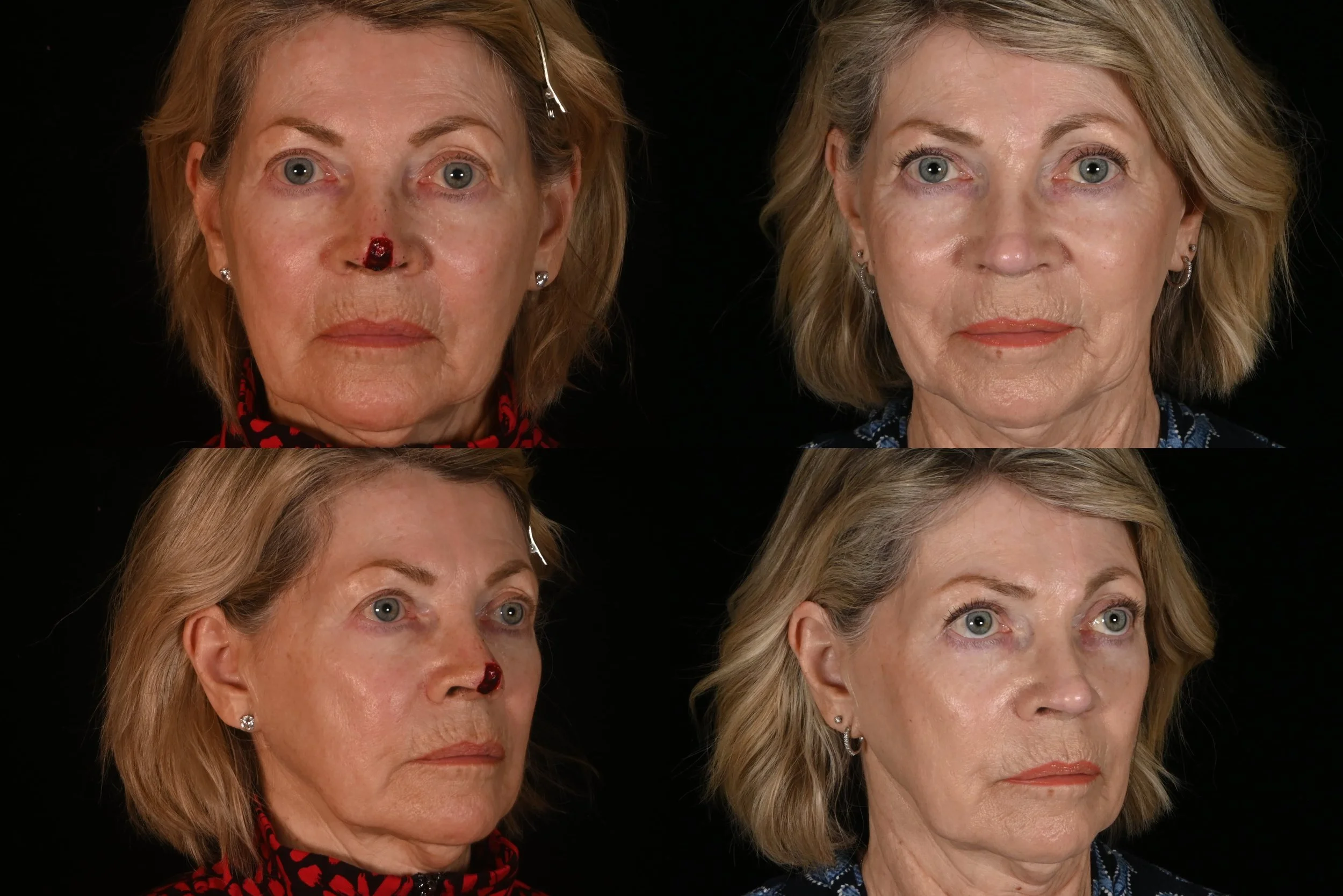 Side-by-side comparison of a middle-aged woman's face before and after cosmetic treatment, showing improved skin appearance and reduced signs of aging.