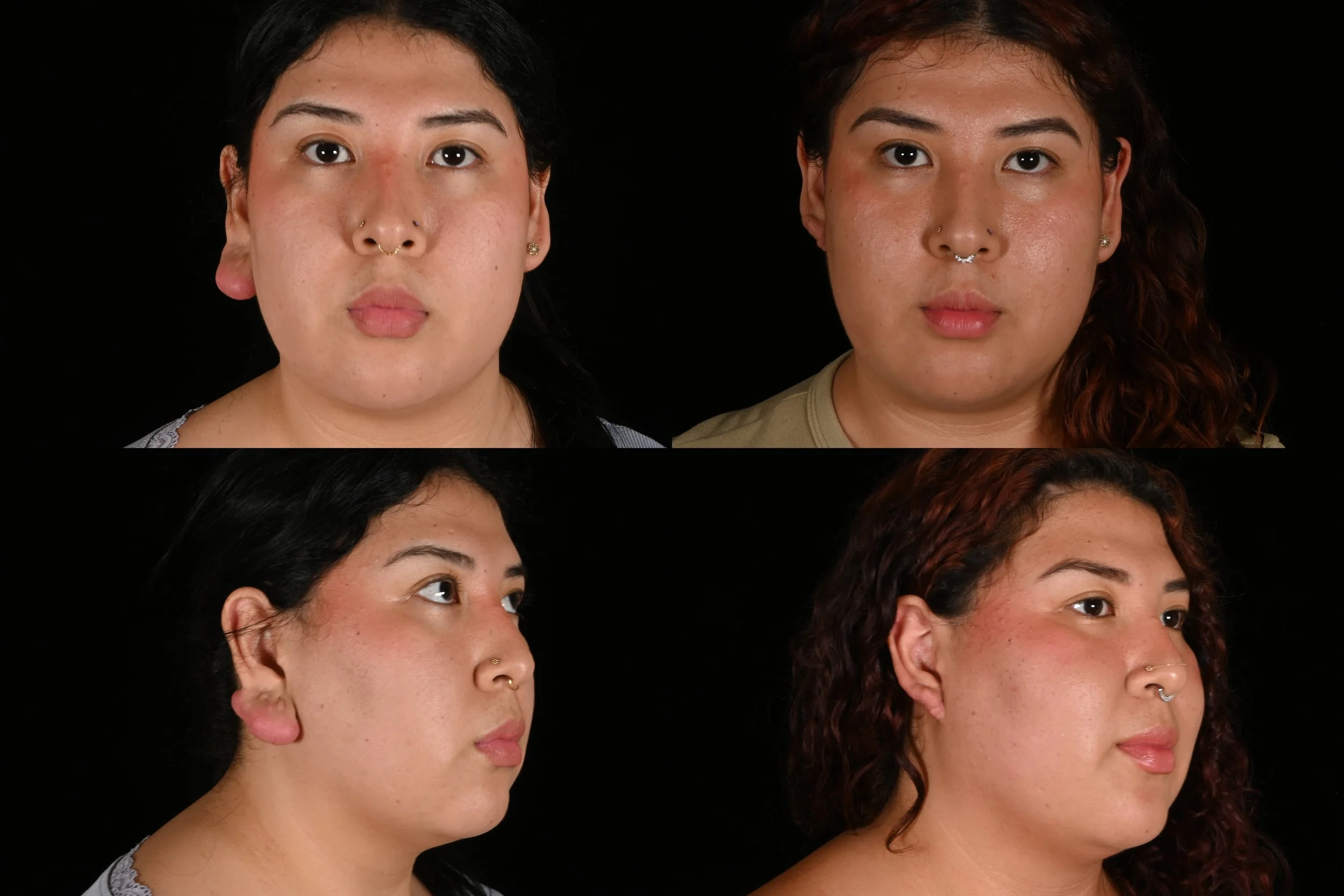 Keloid ear surgery