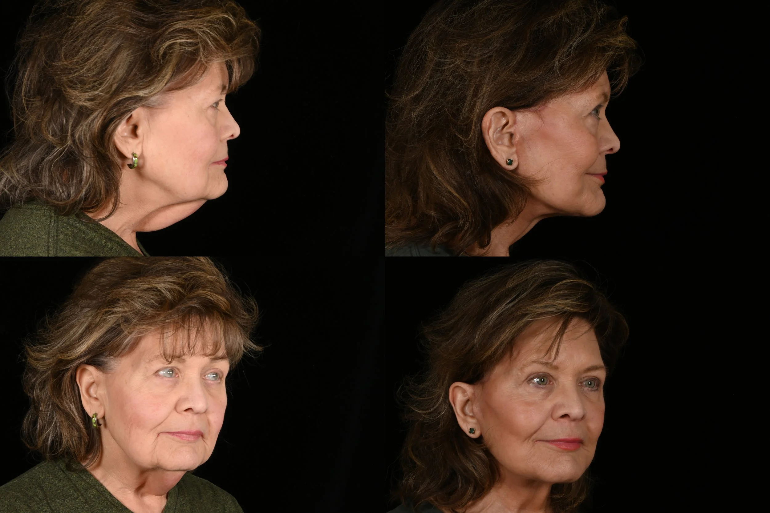 deep plane facelift neck lift fat grafting massive weight loss glp-1 brow lift upper eyelid surgery lower blepharoplasty co2 laser ablative